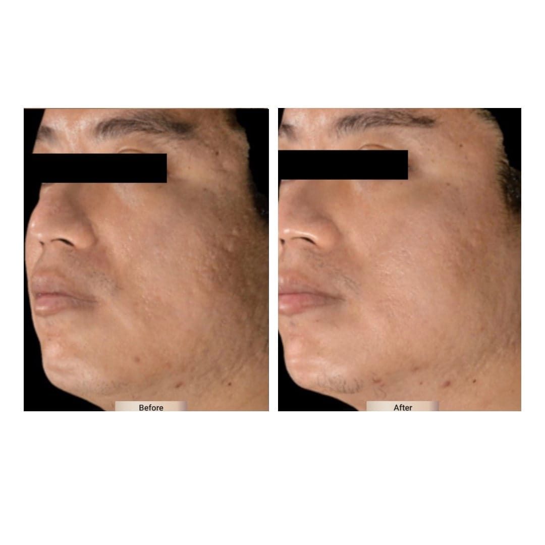 Before and after result 3 for Sylfirm X treatment at Healthy Look Aesthetic