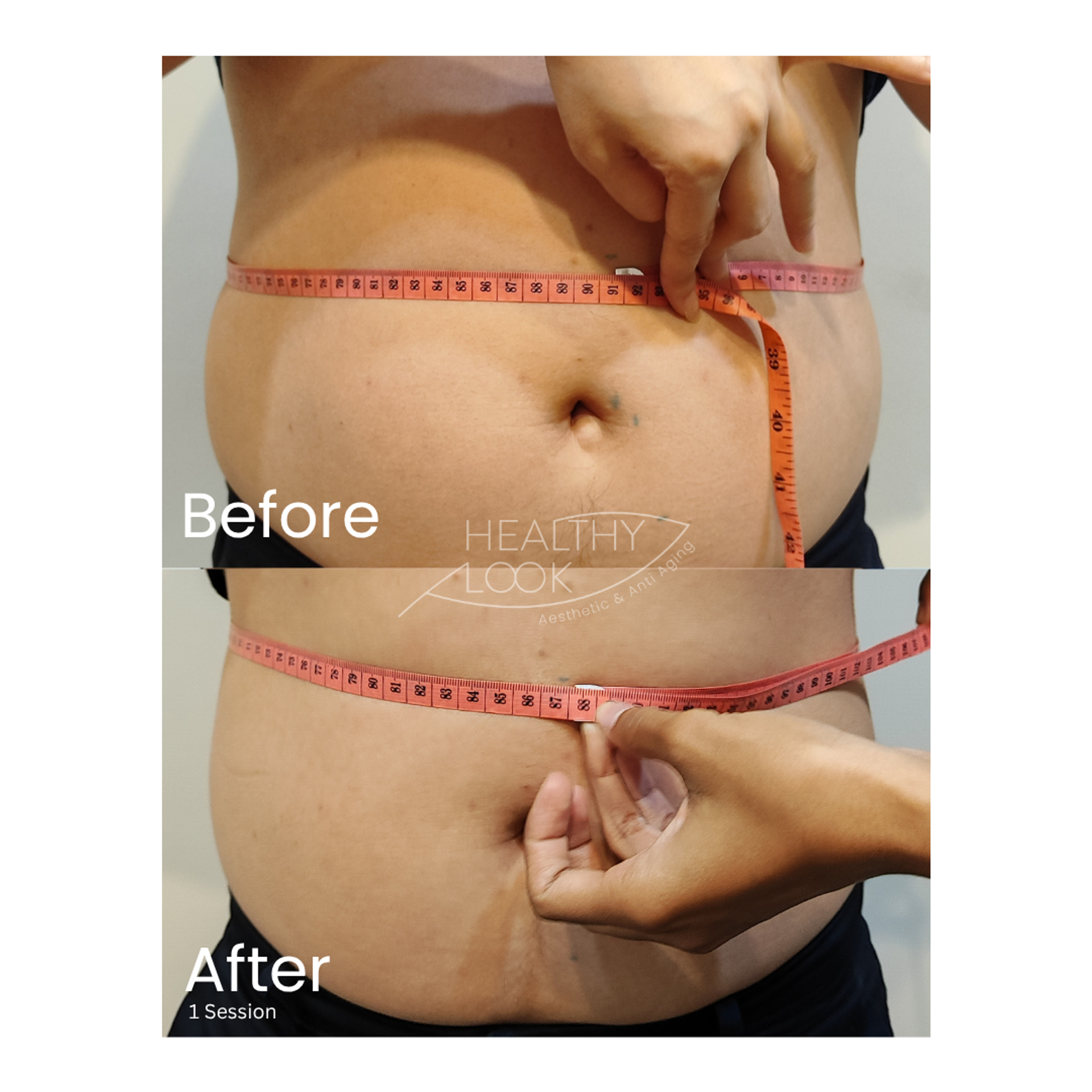 Before and after result 6 for CE Certified Muscle Sculpting by CM Slim treatment at Healthy Look Aesthetic