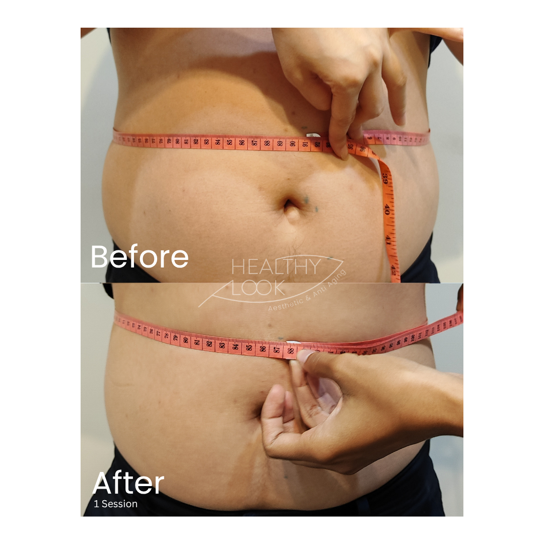 Before and after result 6 for CE Certified Muscle Sculpting by CM Slim treatment at Healthy Look Aesthetic