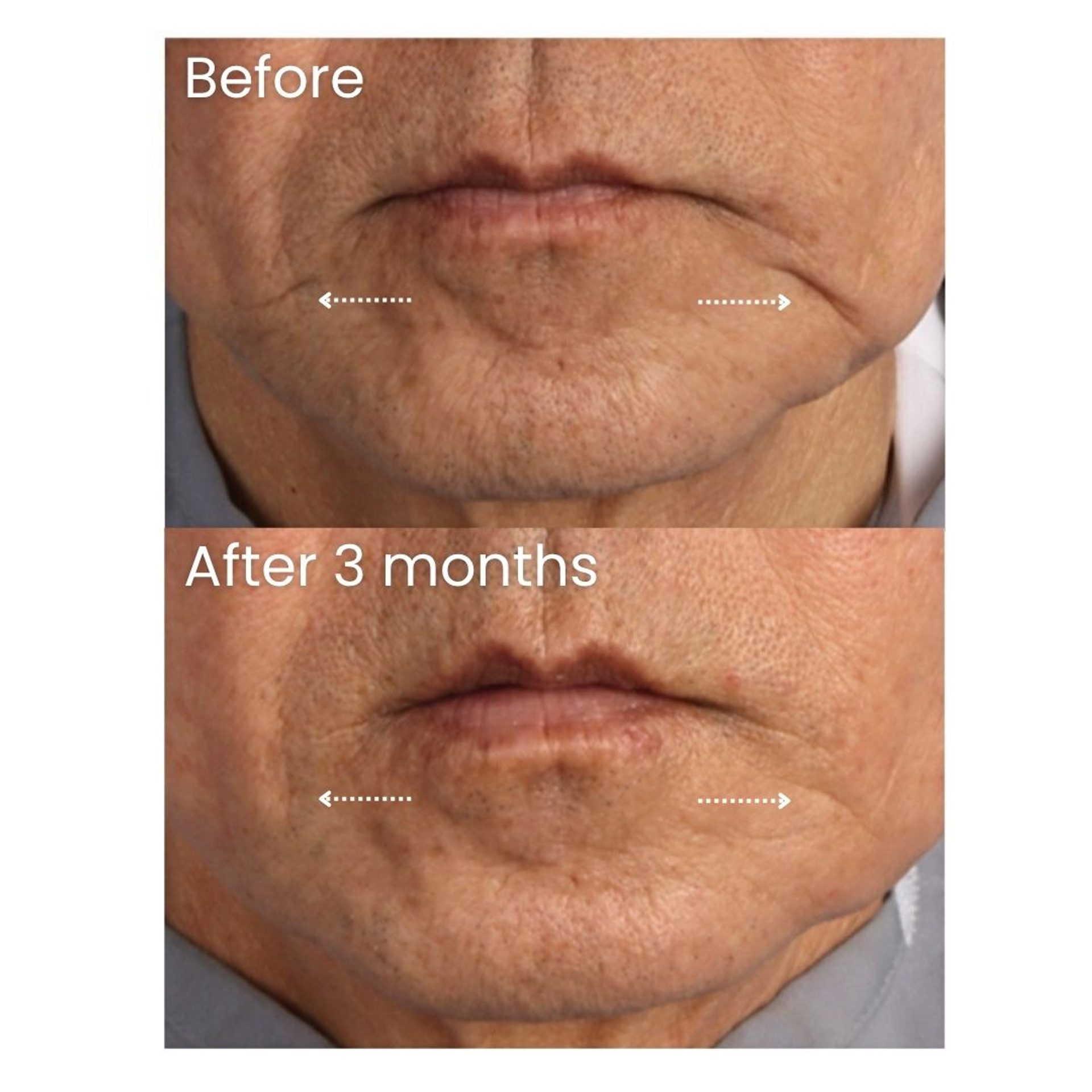 Before and after XERF Treatment at Healthy Look Aesthetic, Ubud