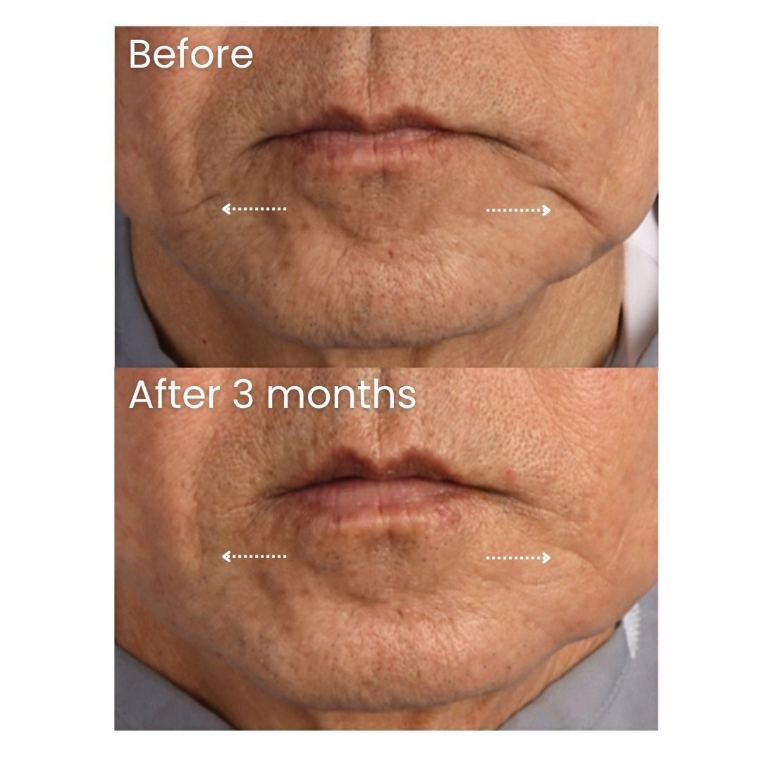 Before and after XERF Treatment at Healthy Look Aesthetic, Ubud