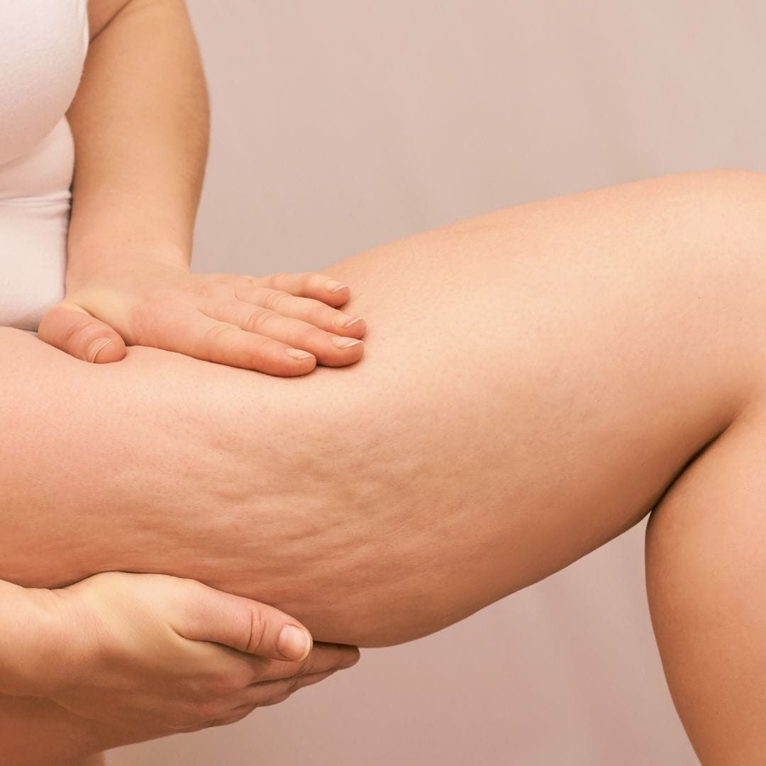 Carboxy therapy treatment