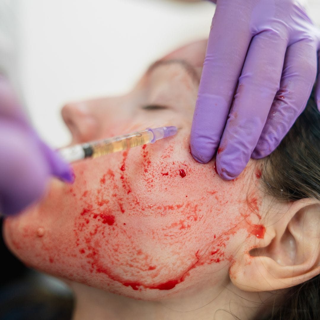 PRP Vampire Facial