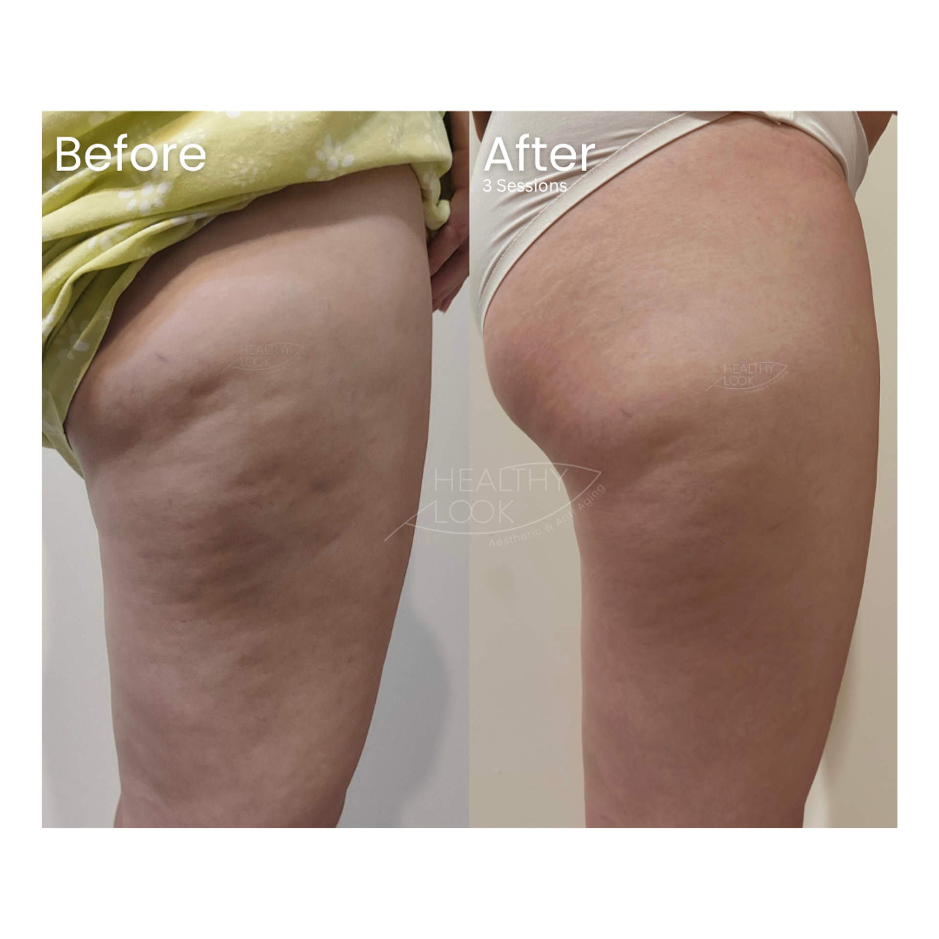 Before and after result 1 for Lysiwave treatment at Healthy Look Aesthetic