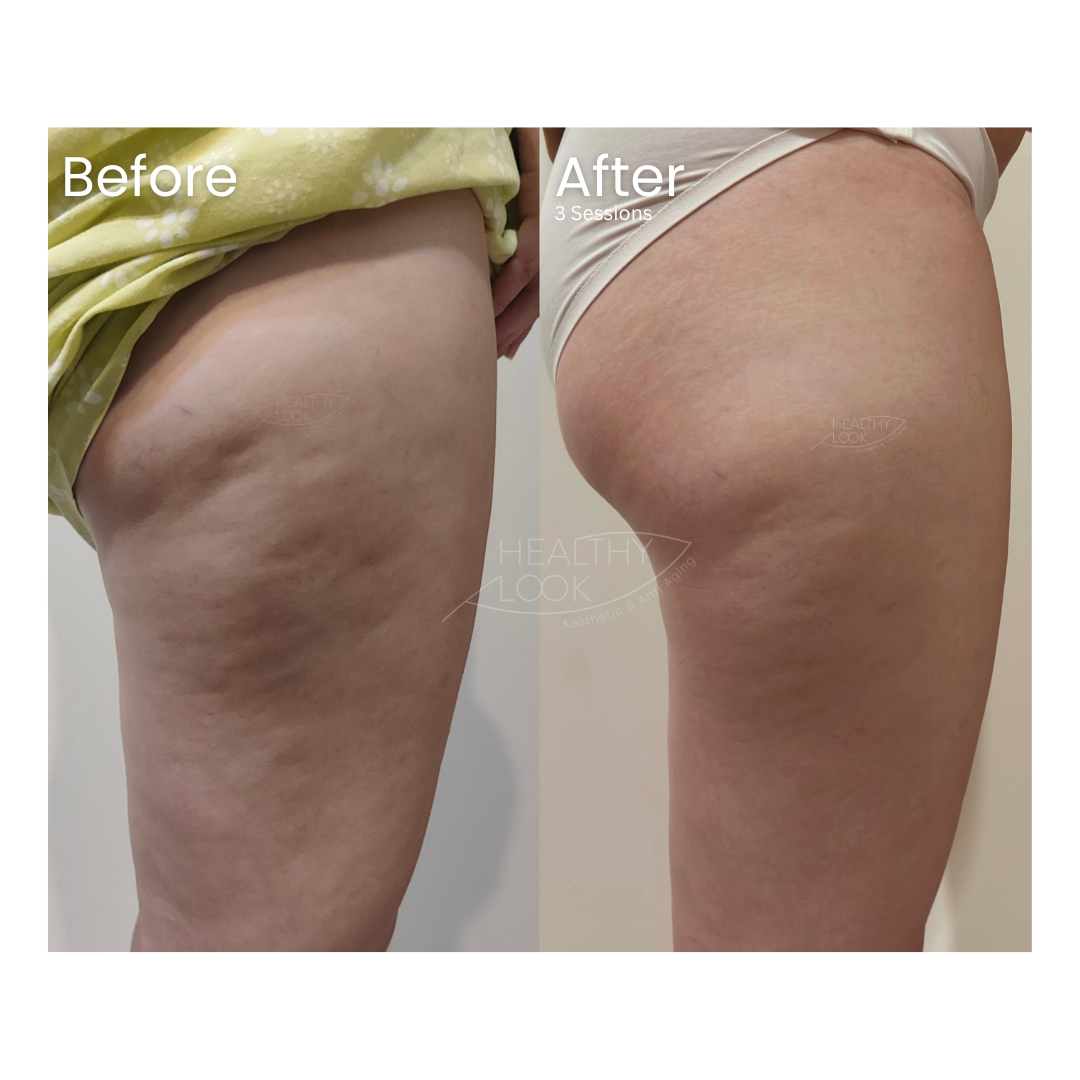 Before and after result 1 for Lysiwave treatment at Healthy Look Aesthetic