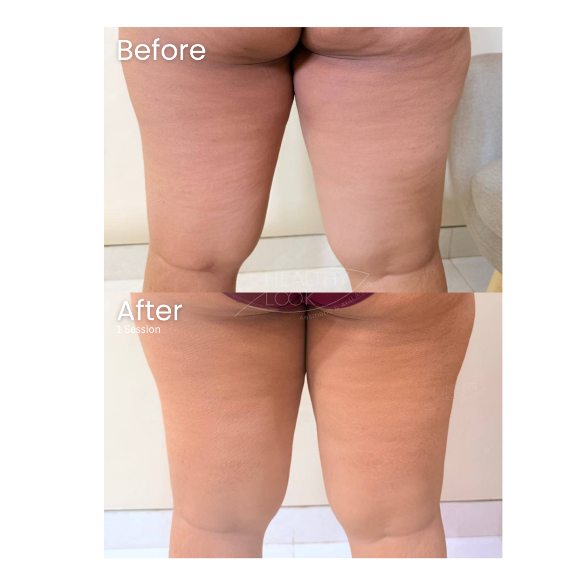 Before and after result 7 for Lysiwave treatment at Healthy Look Aesthetic