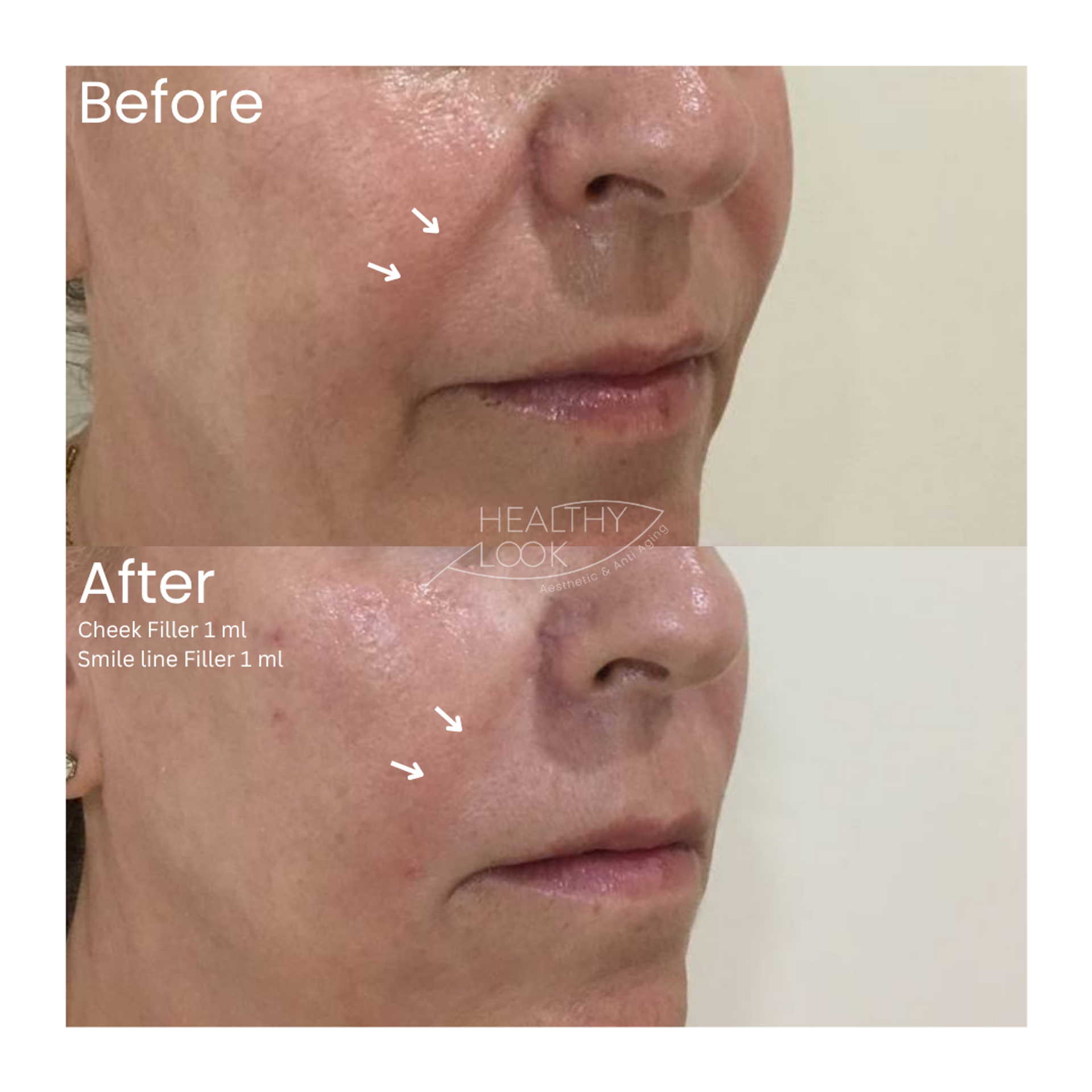 Before and after result 3 for Dermal Filler treatment at Healthy Look Aesthetic