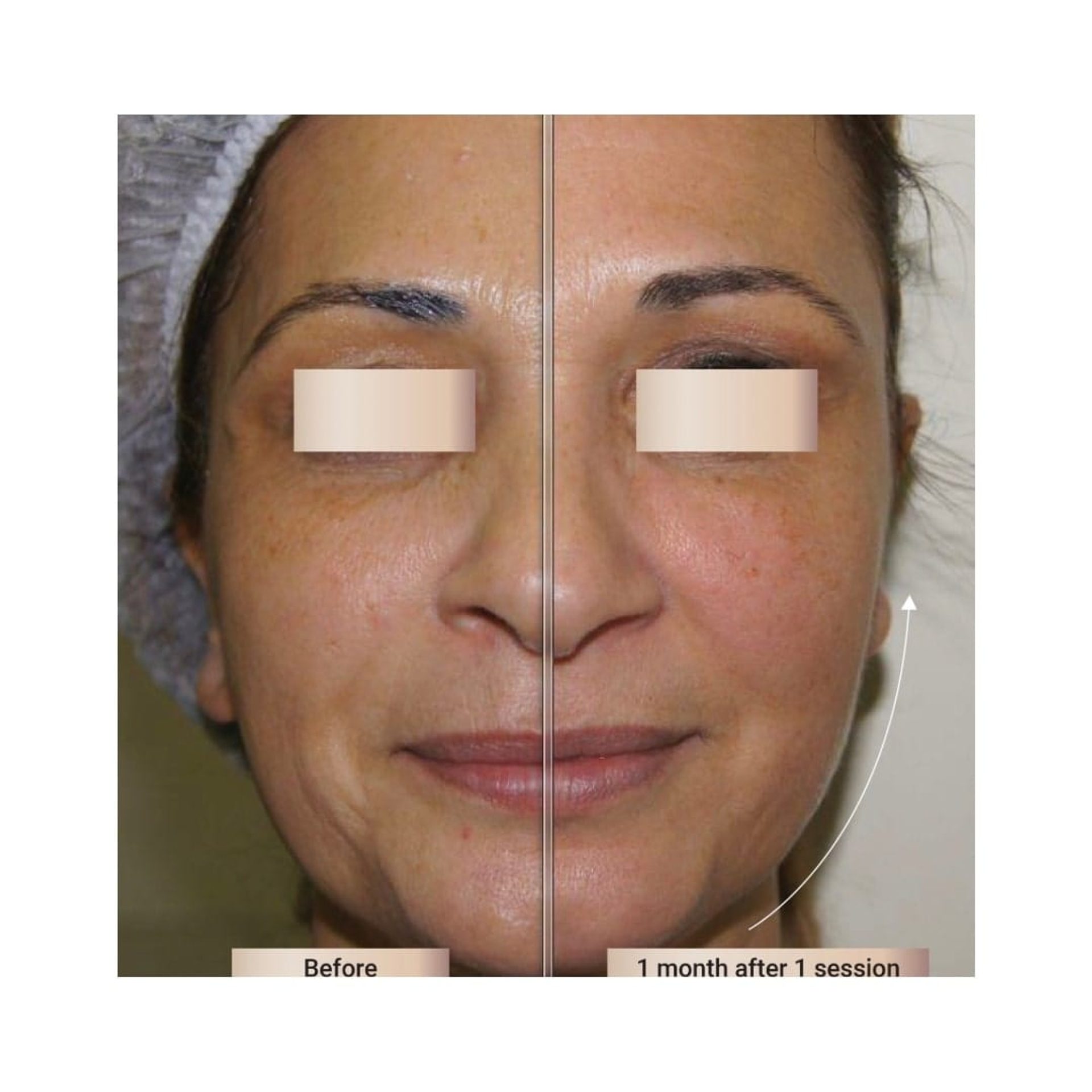 Before and after result 7 for Sylfirm X treatment at Healthy Look Aesthetic