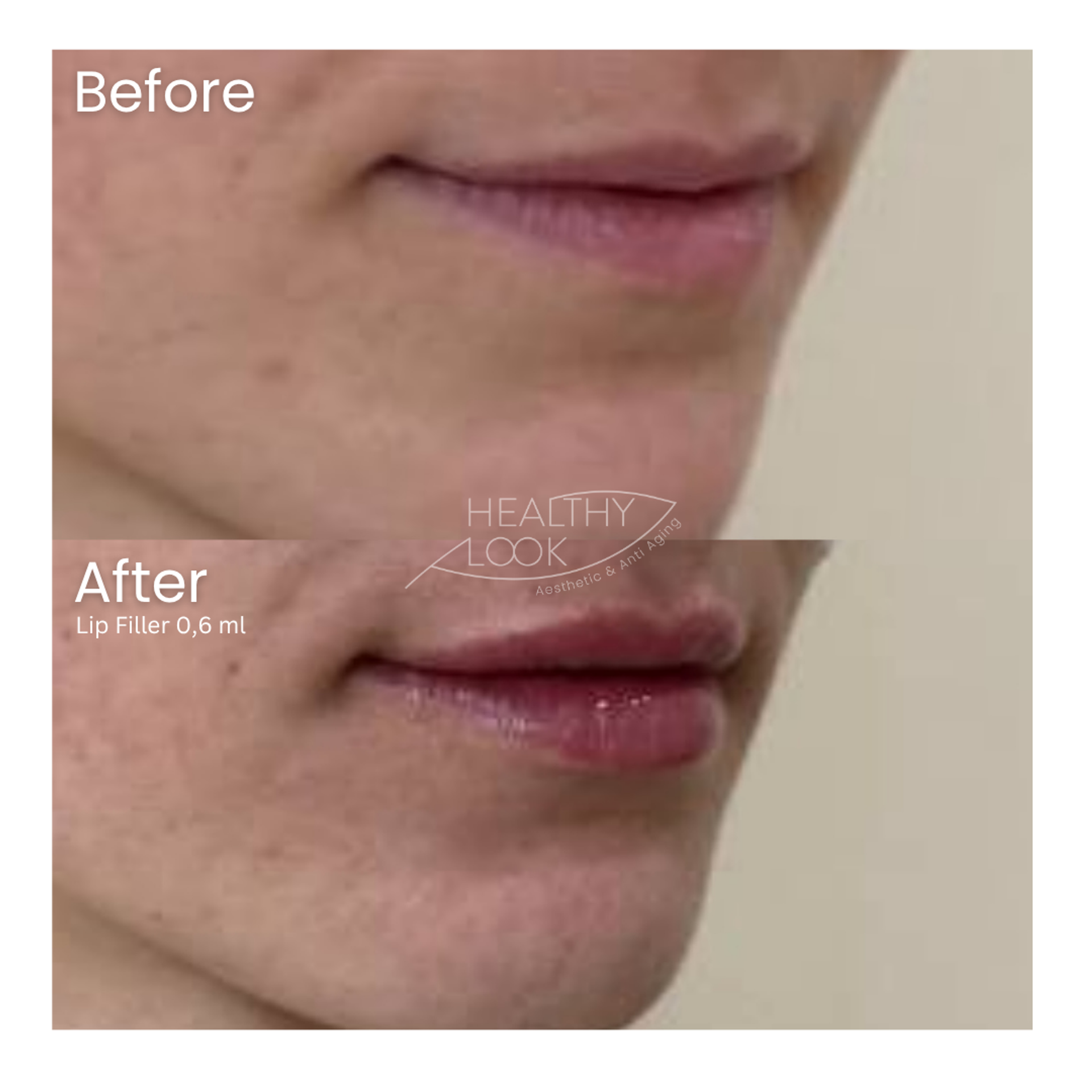 Before and after result 4 for Lip Filler treatment at Healthy Look Aesthetic
