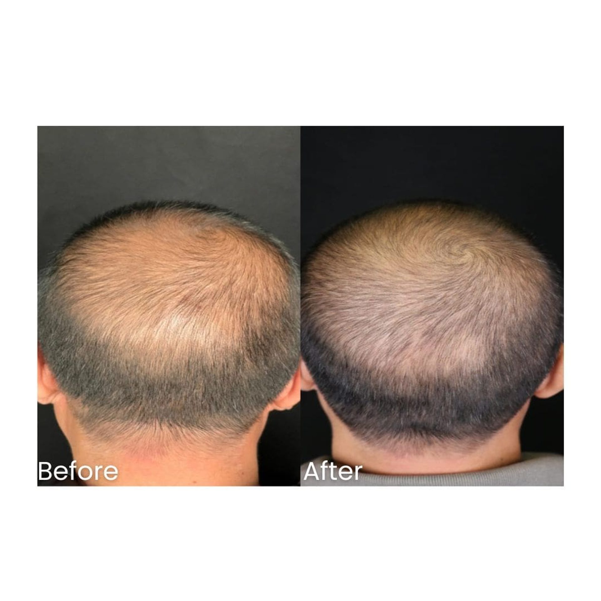 Before and after Autologous Micrograft Hair Restoration at Healthy Look Aesthetic, Ubud