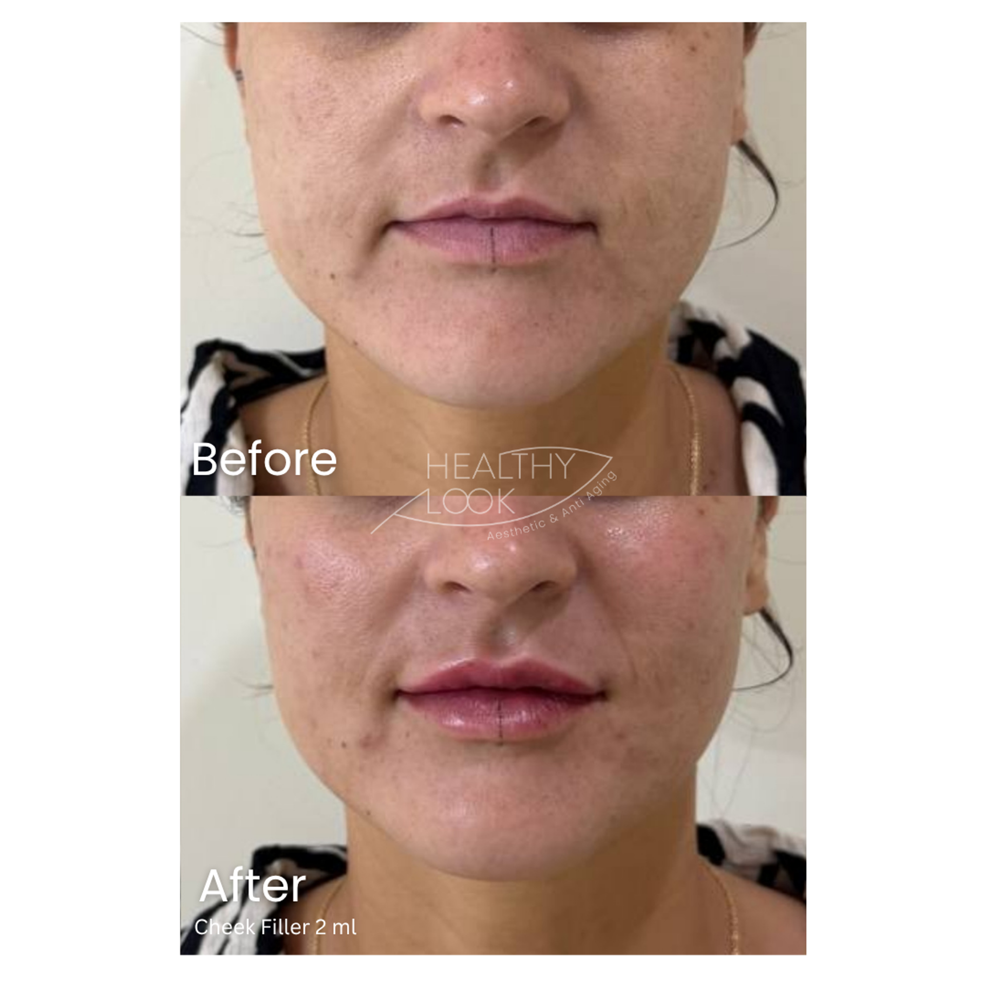 Before and after result 10 for Dermal Filler treatment at Healthy Look Aesthetic