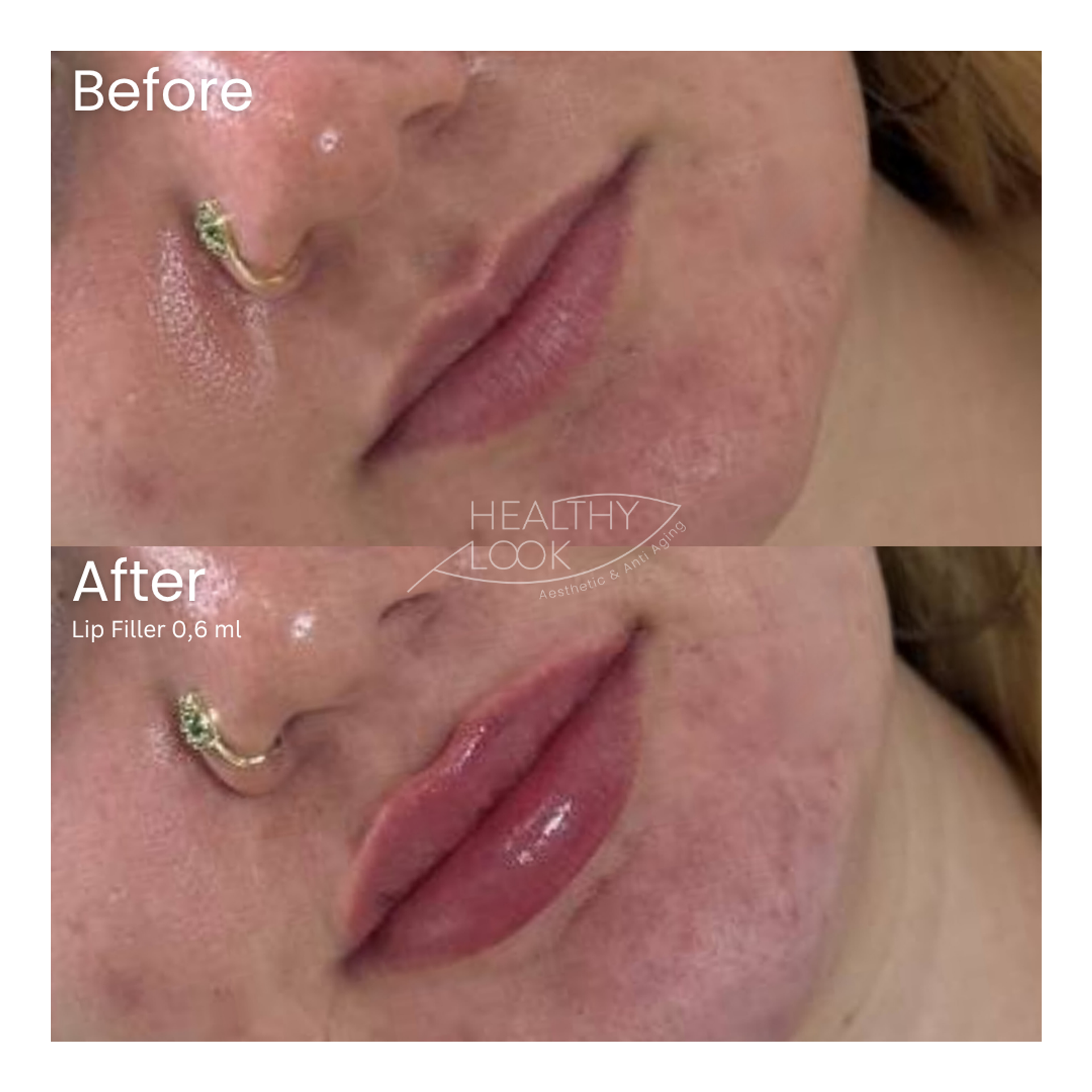Before and after result 8 for Lip Filler treatment at Healthy Look Aesthetic