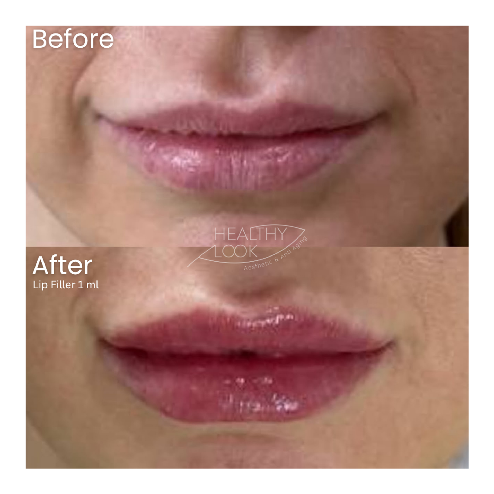 Lip Filler before and after result