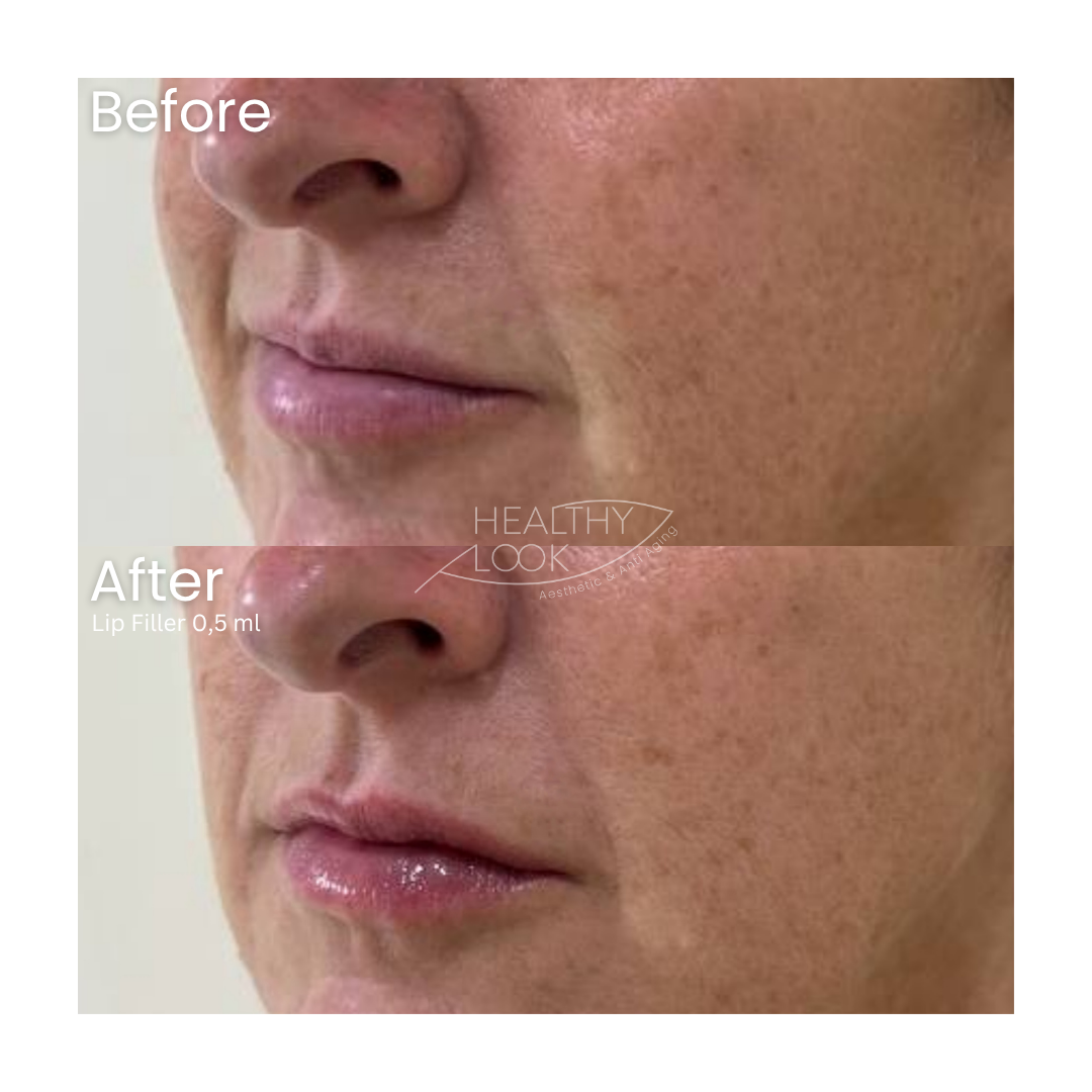 Before and after result 24 for Lip Filler treatment at Healthy Look Aesthetic