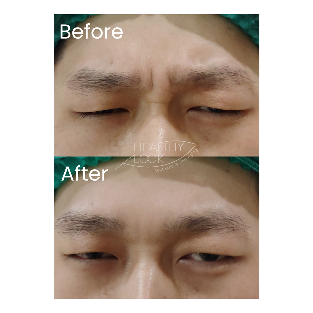 Before and after result 9 for Botox treatment at Healthy Look Aesthetic