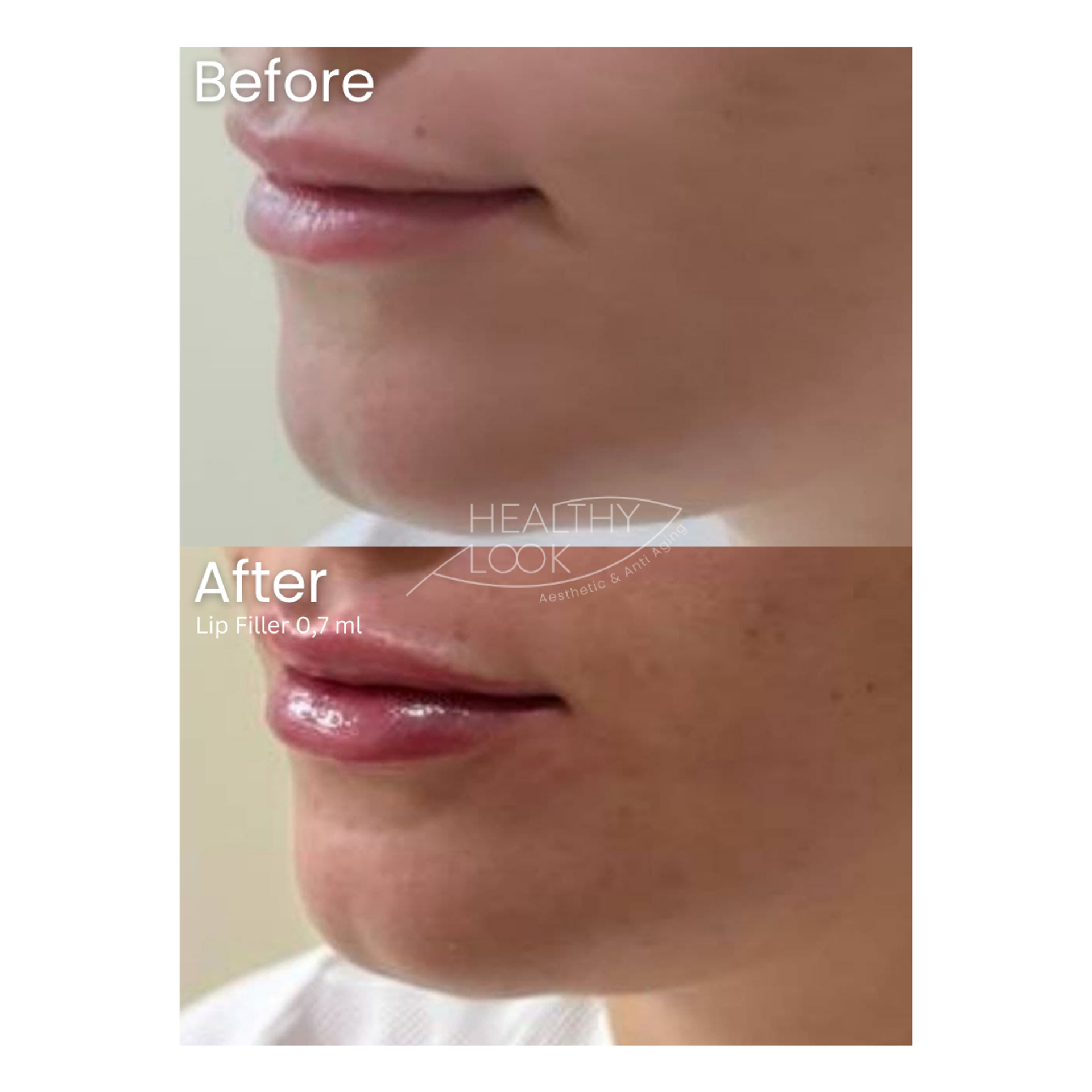 Before and after result 16 for Lip Filler treatment at Healthy Look Aesthetic