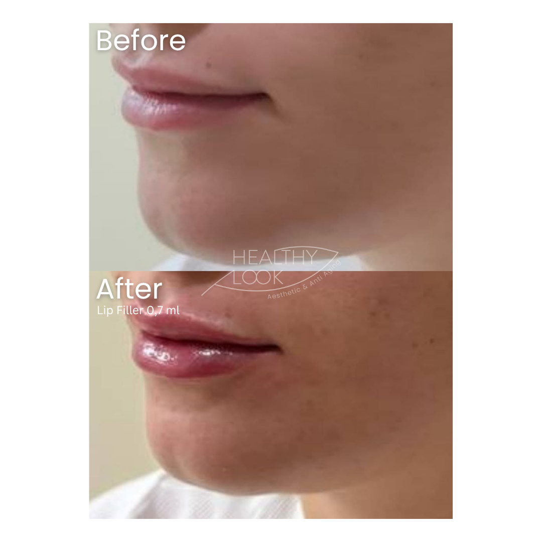 Before and after result 16 for Lip Filler treatment at Healthy Look Aesthetic