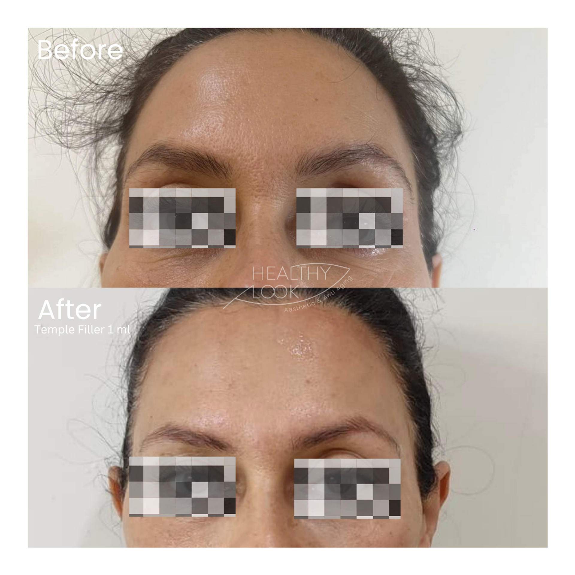 Before and after result 7 for Dermal Filler treatment at Healthy Look Aesthetic