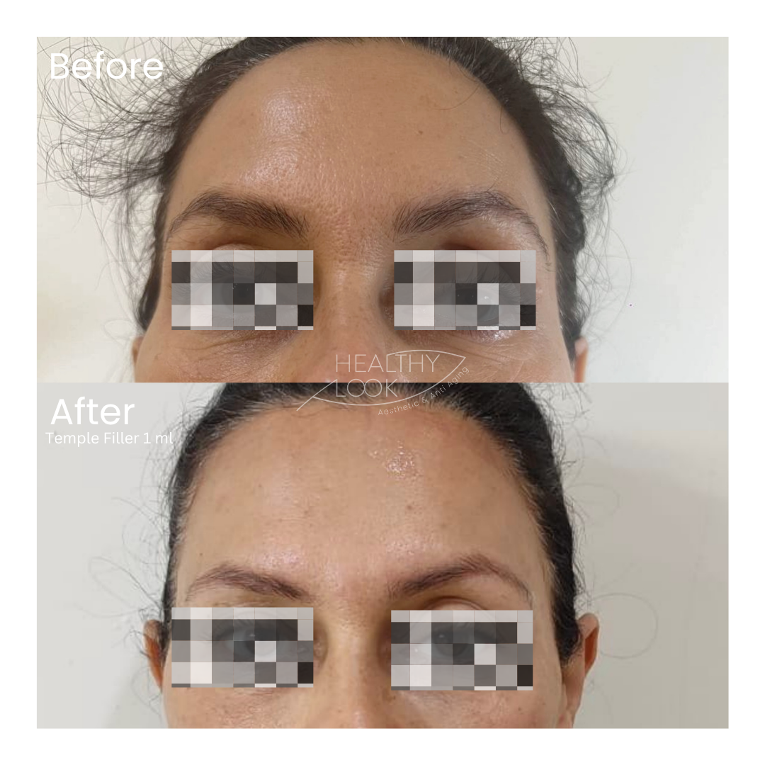 Before and after result 7 for Dermal Filler treatment at Healthy Look Aesthetic