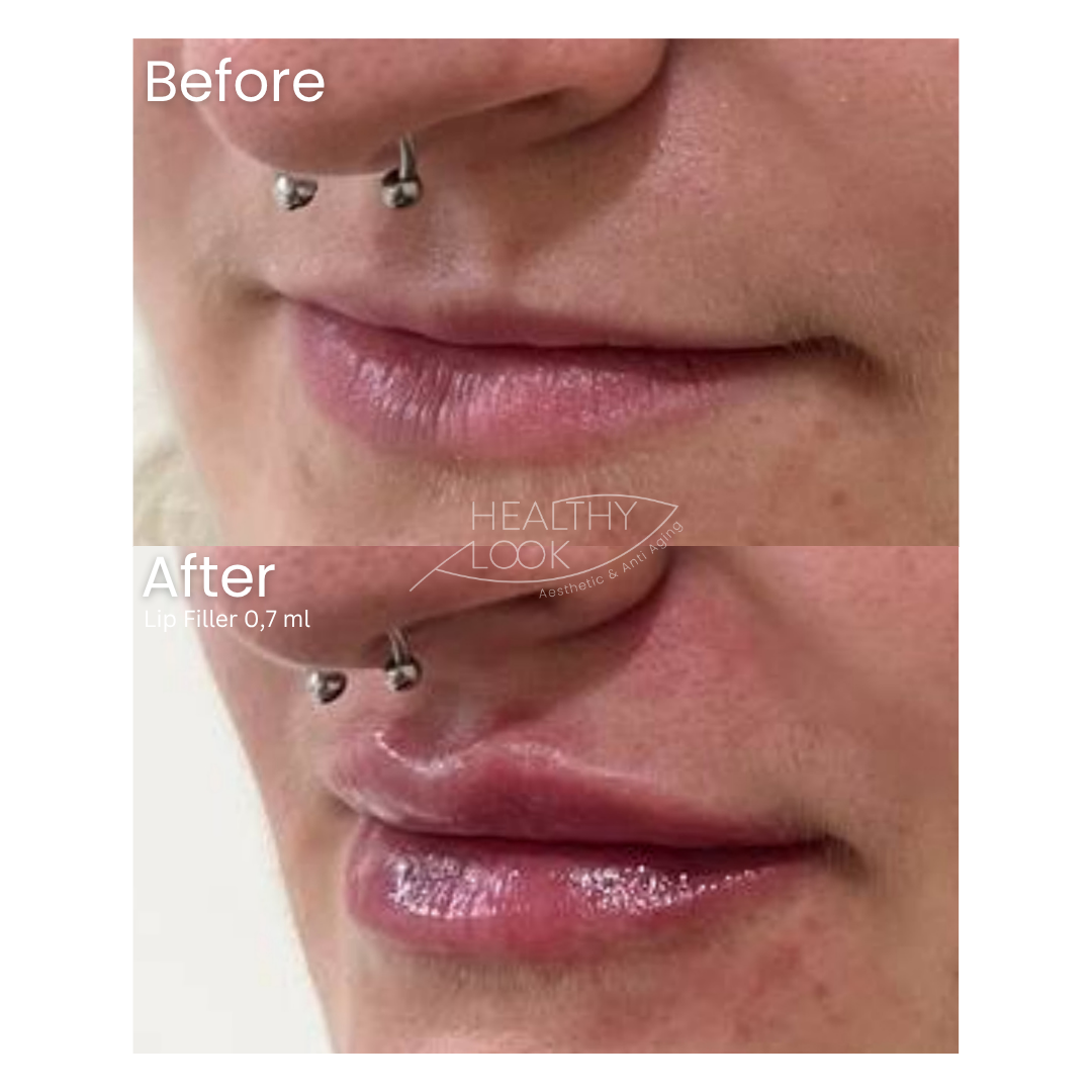 Before and after result 13 for Lip Filler treatment at Healthy Look Aesthetic