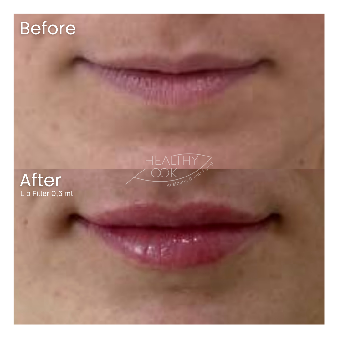 Before and after result 3 for Lip Filler treatment at Healthy Look Aesthetic