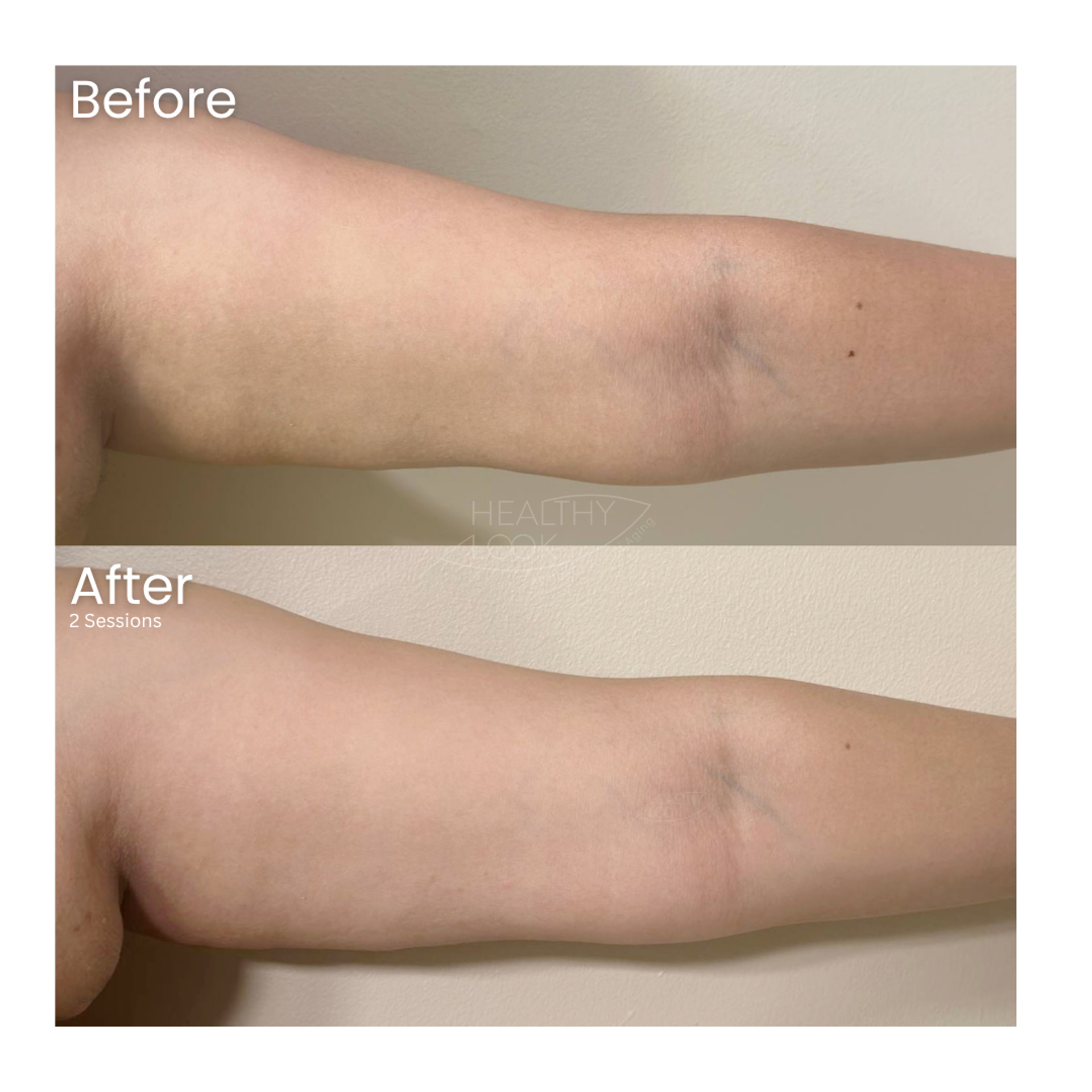 Before and after result 5 for Lysiwave treatment at Healthy Look Aesthetic