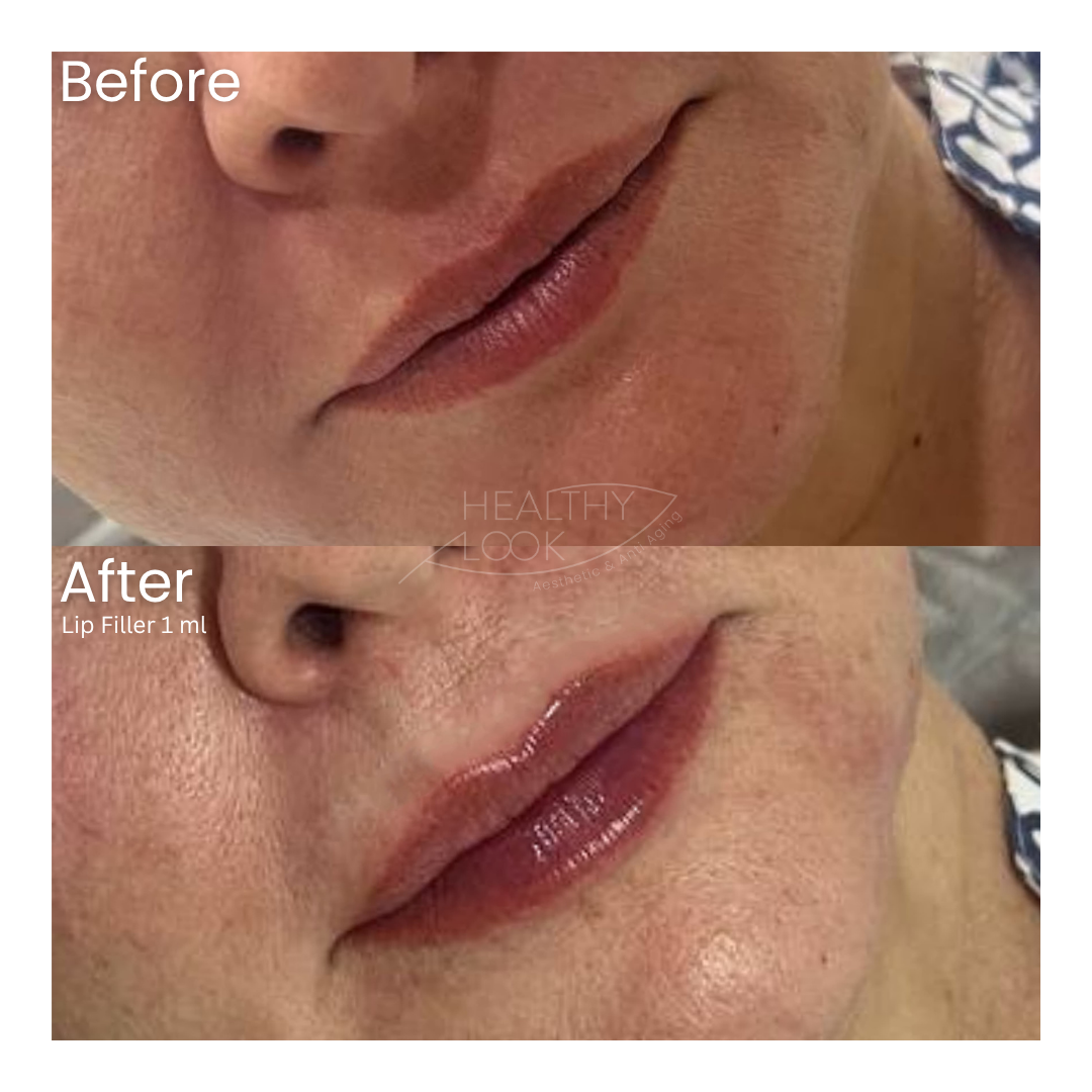 Before and after result 7 for Lip Filler treatment at Healthy Look Aesthetic