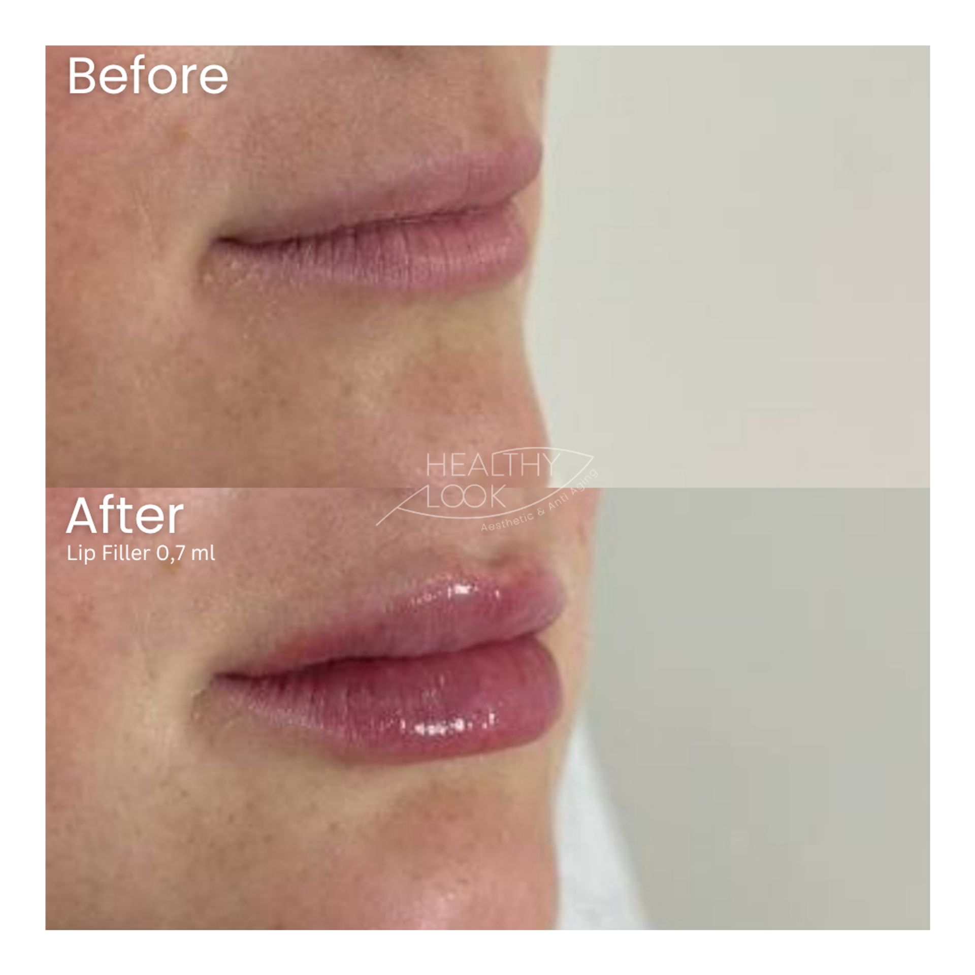Before and after result 22 for Lip Filler treatment at Healthy Look Aesthetic