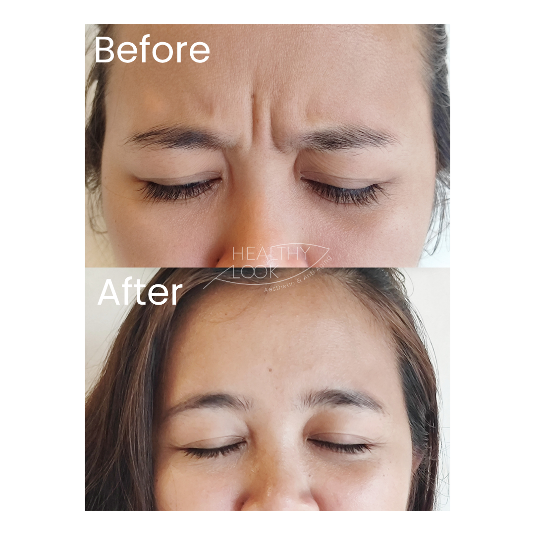 Before and after result 5 for Botox treatment at Healthy Look Aesthetic