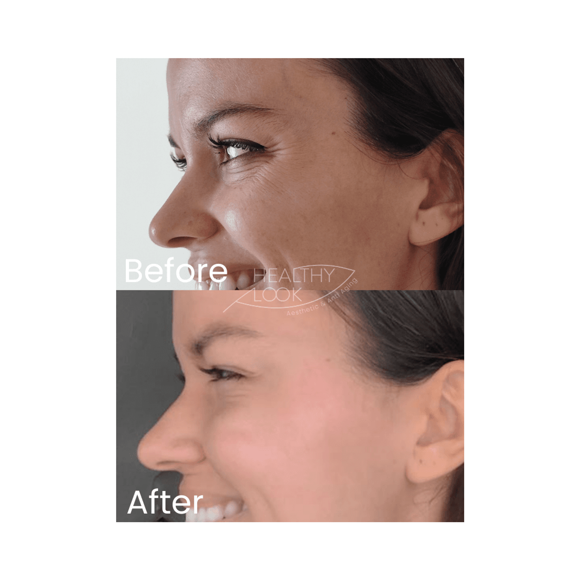 Botox before and after result