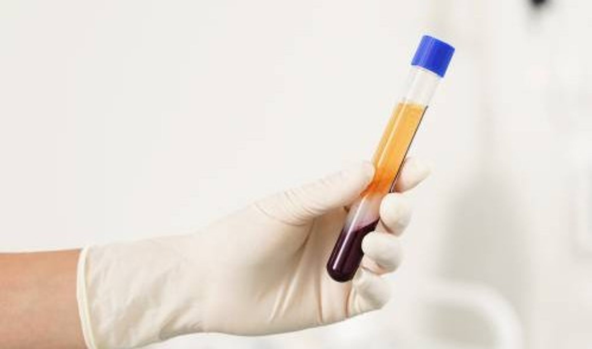 Micrograft suspension mixed with PRP