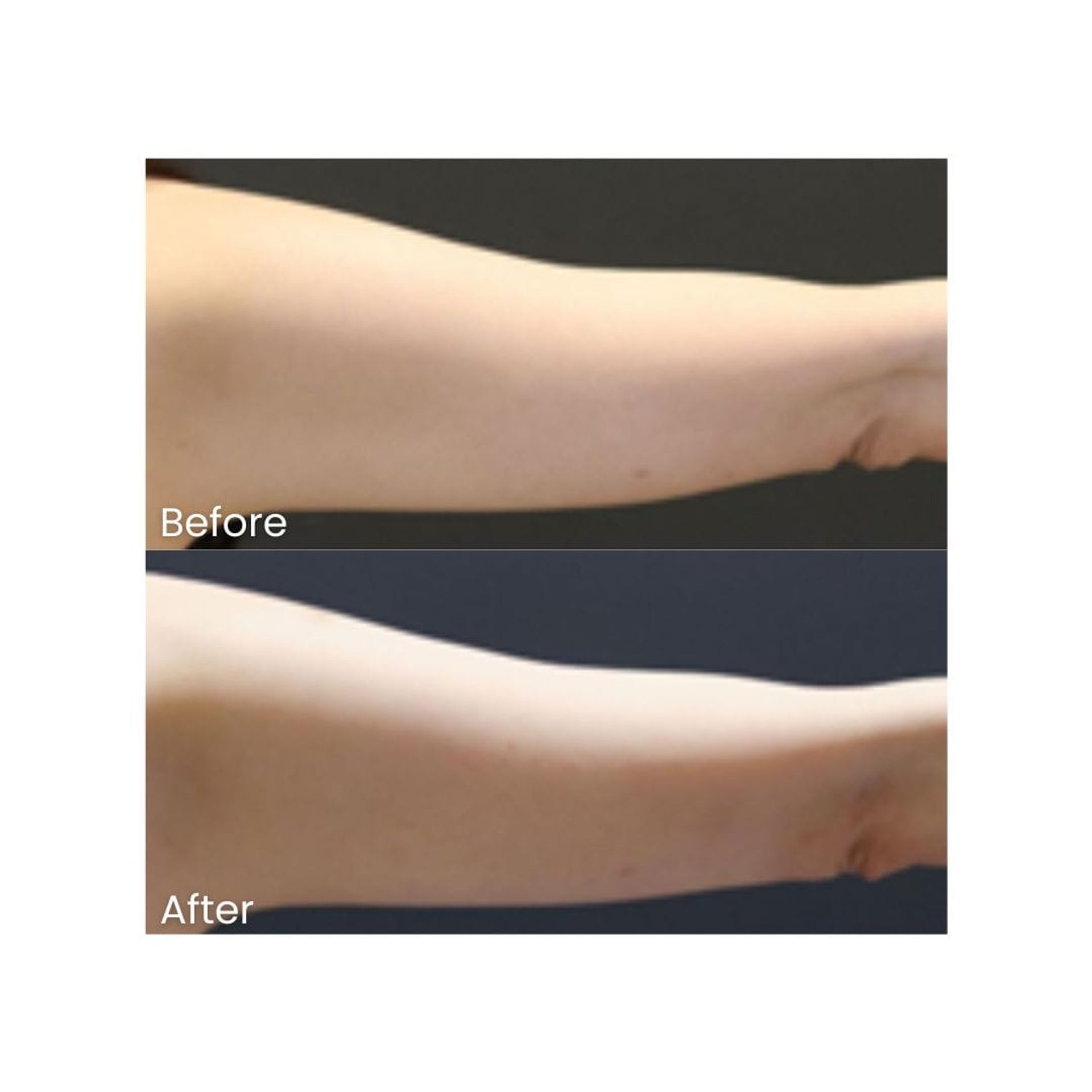 Before and after HIFU Body at Healthy Look Aesthetic, Ubud