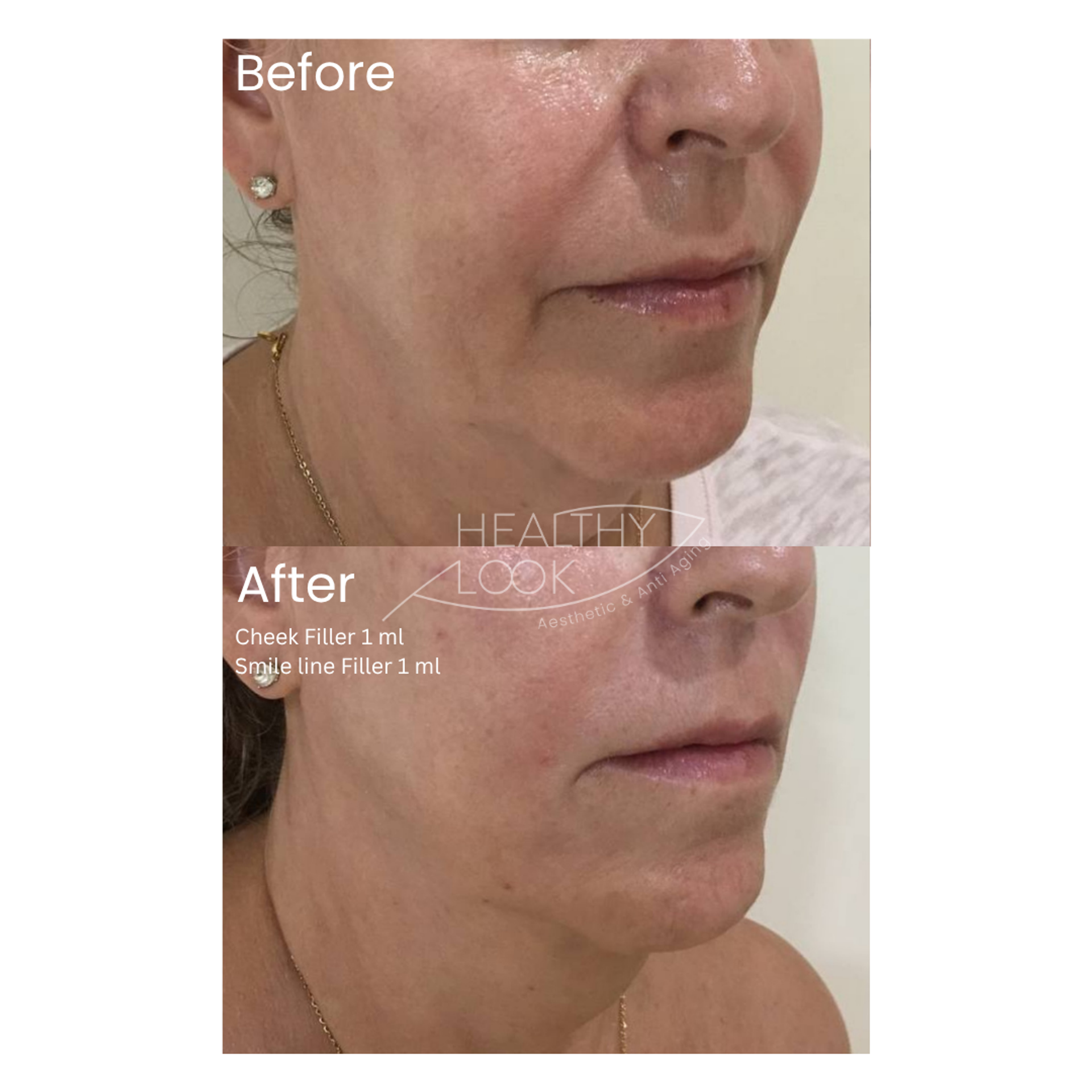 Before and after result 5 for Dermal Filler treatment at Healthy Look Aesthetic