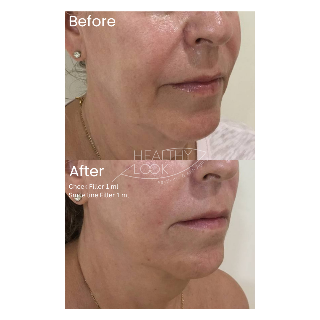 Before and after result 5 for Dermal Filler treatment at Healthy Look Aesthetic