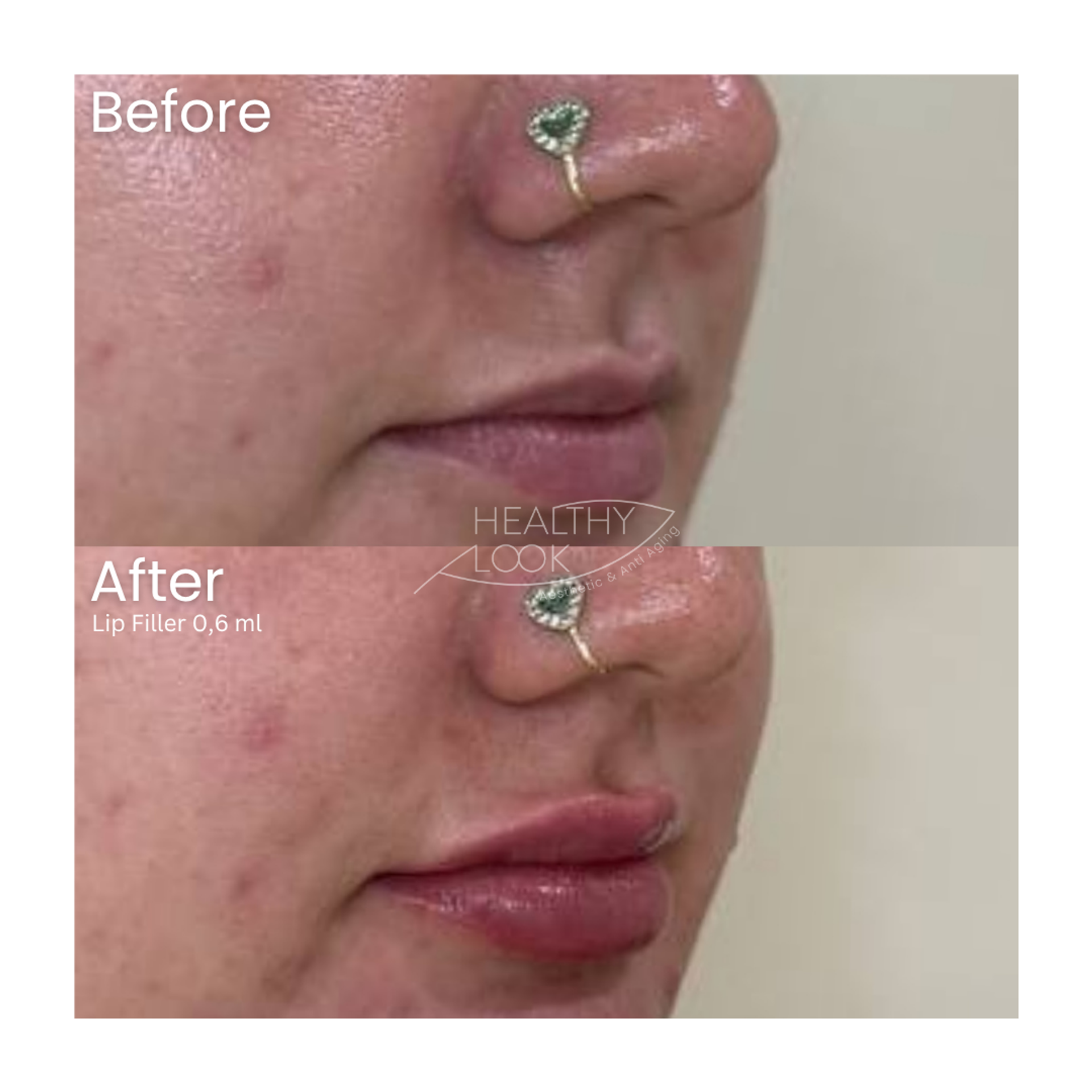 Before and after result 9 for Lip Filler treatment at Healthy Look Aesthetic