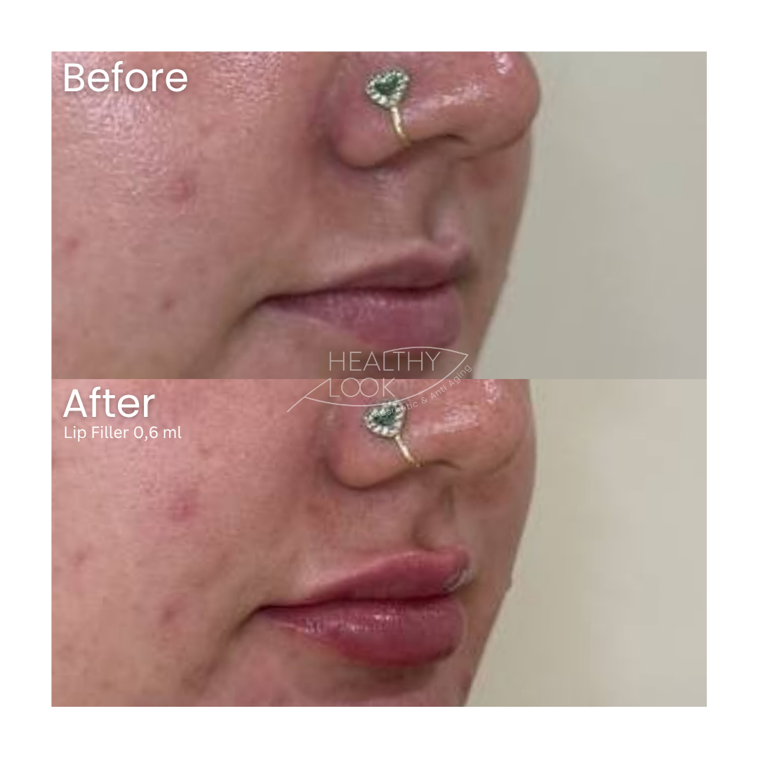 Before and after result 9 for Lip Filler treatment at Healthy Look Aesthetic
