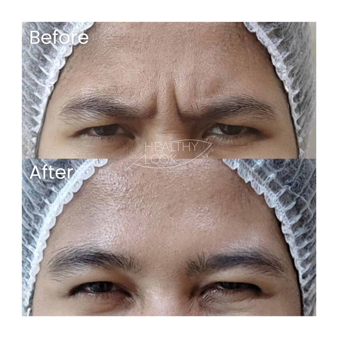 Before and after result 16 for Botox treatment at Healthy Look Aesthetic