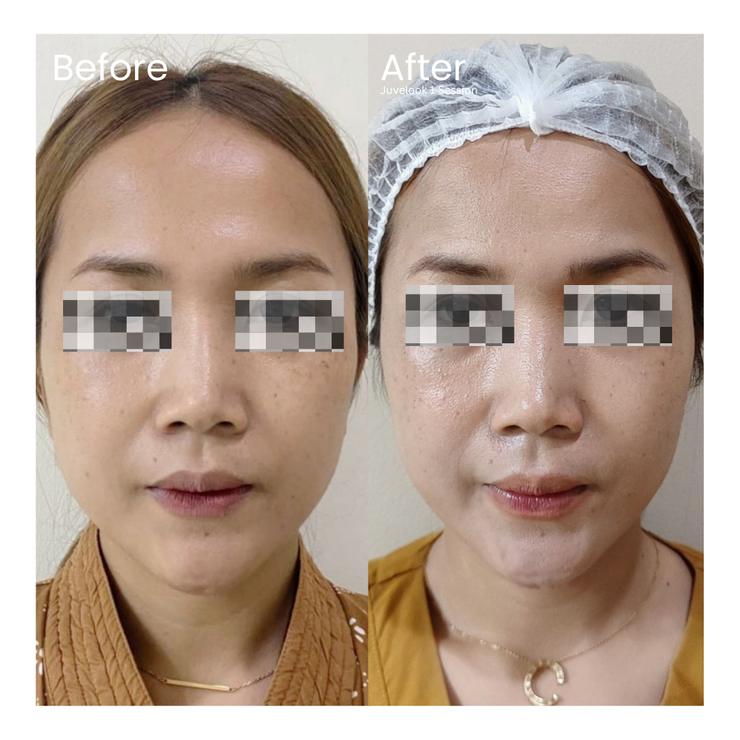 Before and after result 6 for Skin Treatment treatment at Healthy Look Aesthetic