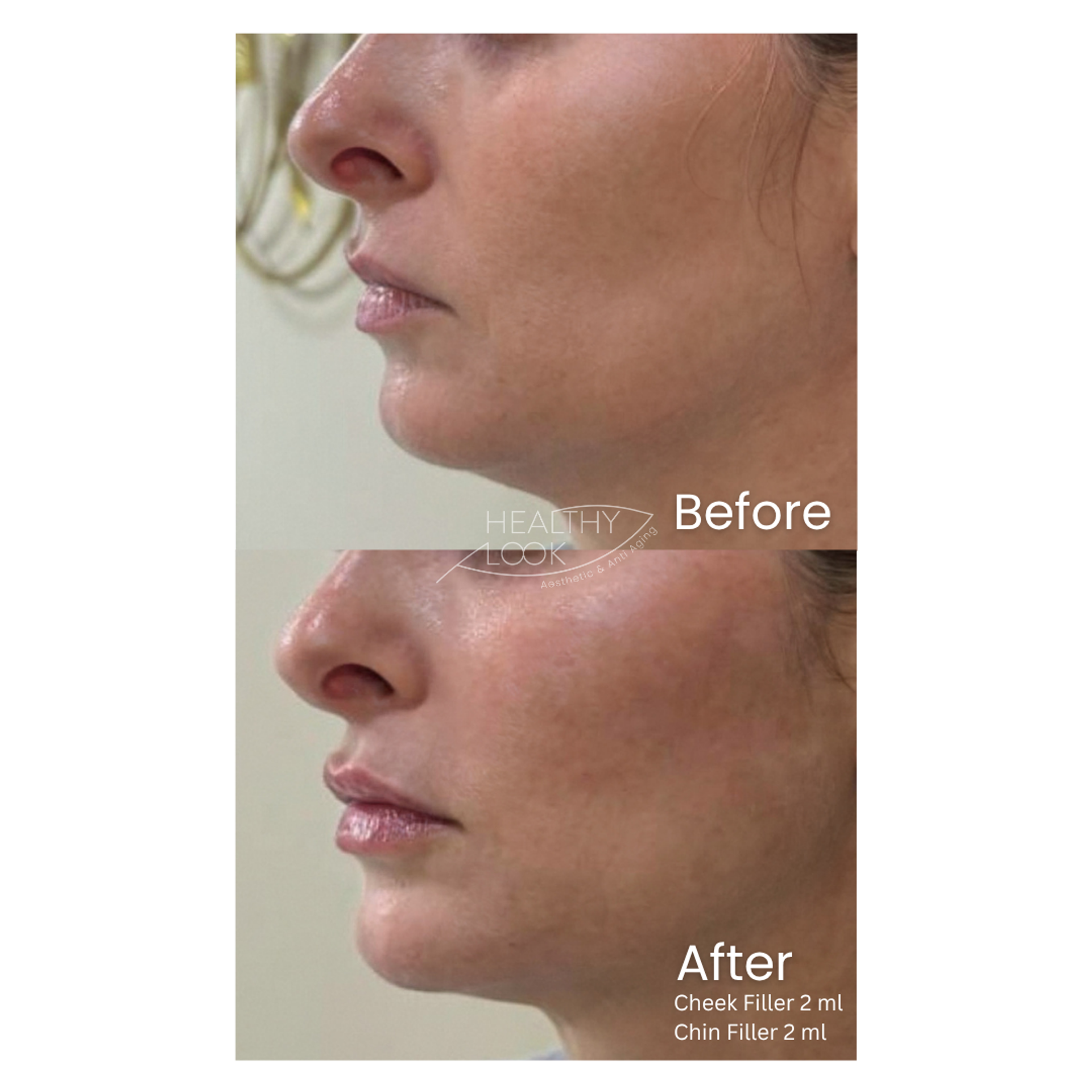 Dermal Filler before and after result