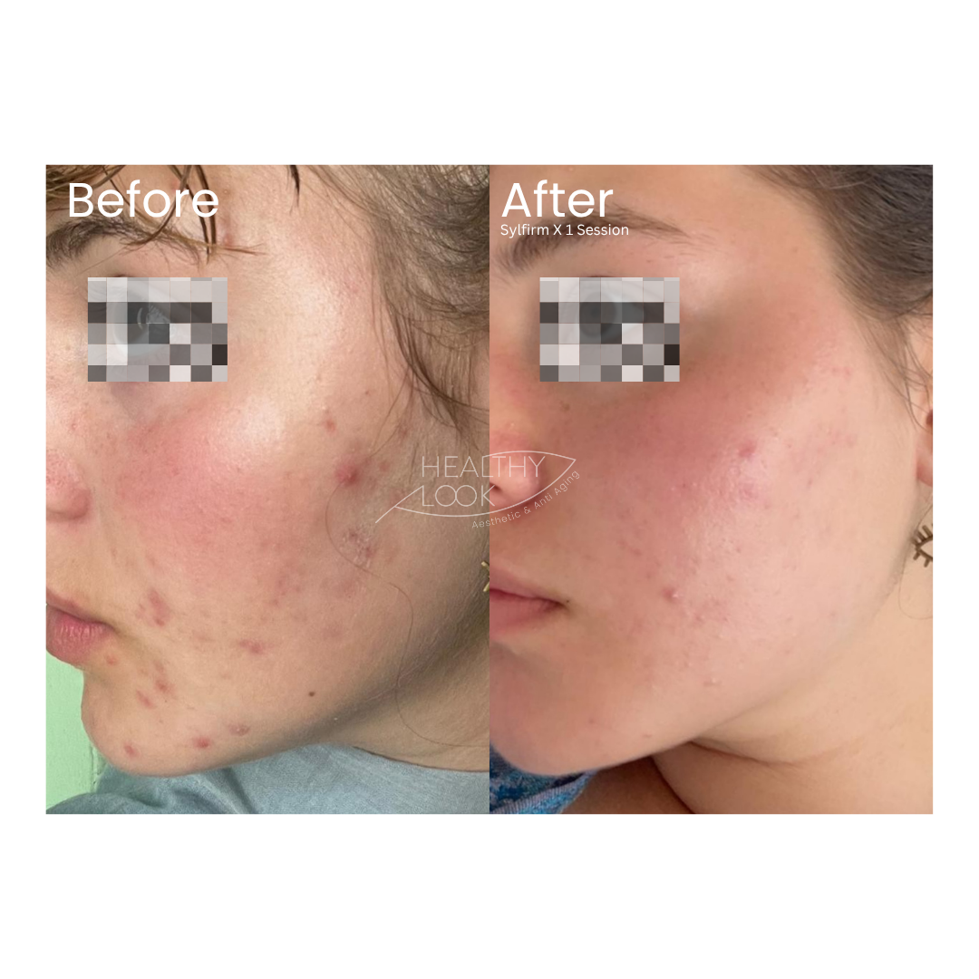 Before and after result 2 for Skin Treatment treatment at Healthy Look Aesthetic