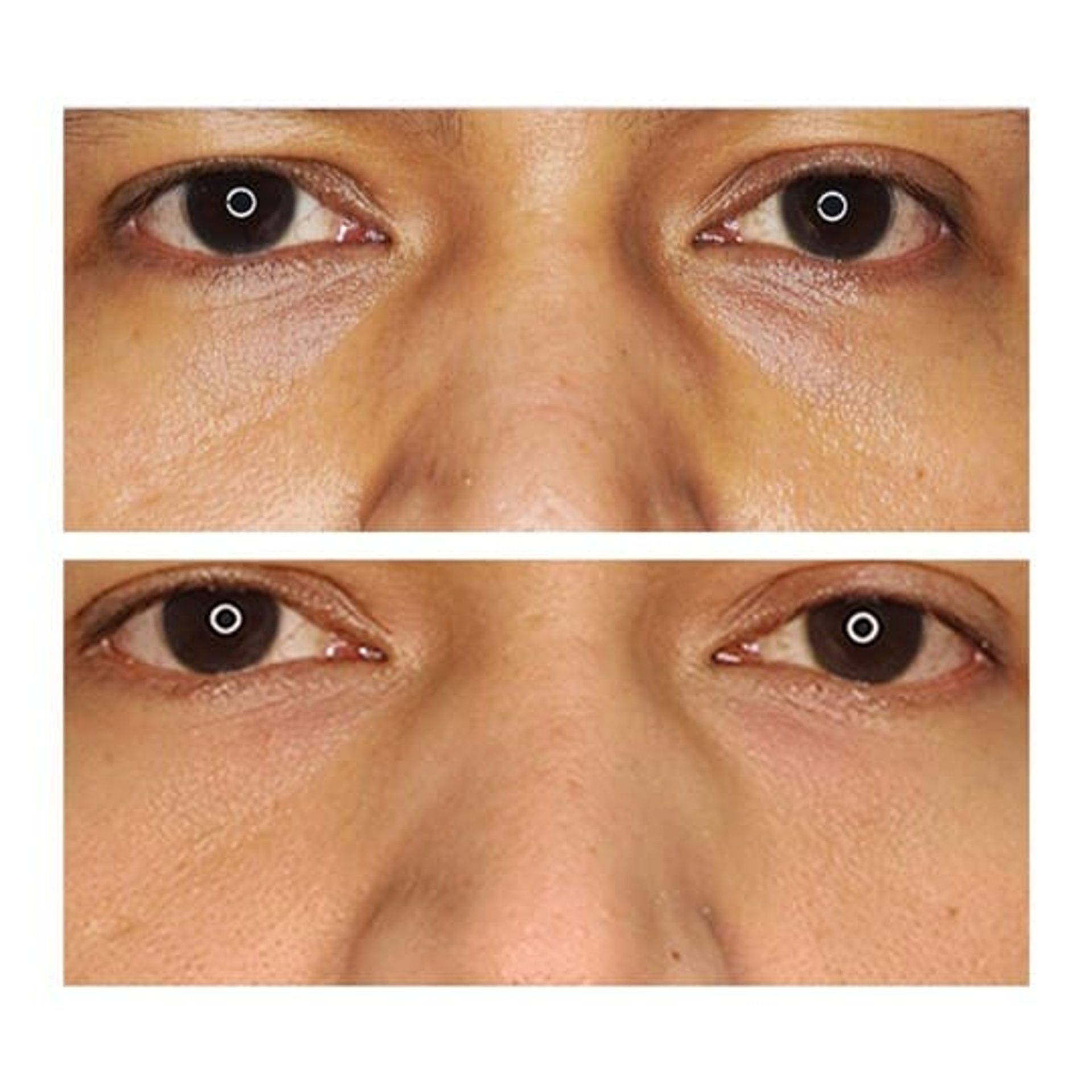 Before and after result 11 for Juvelook treatment at Healthy Look Aesthetic