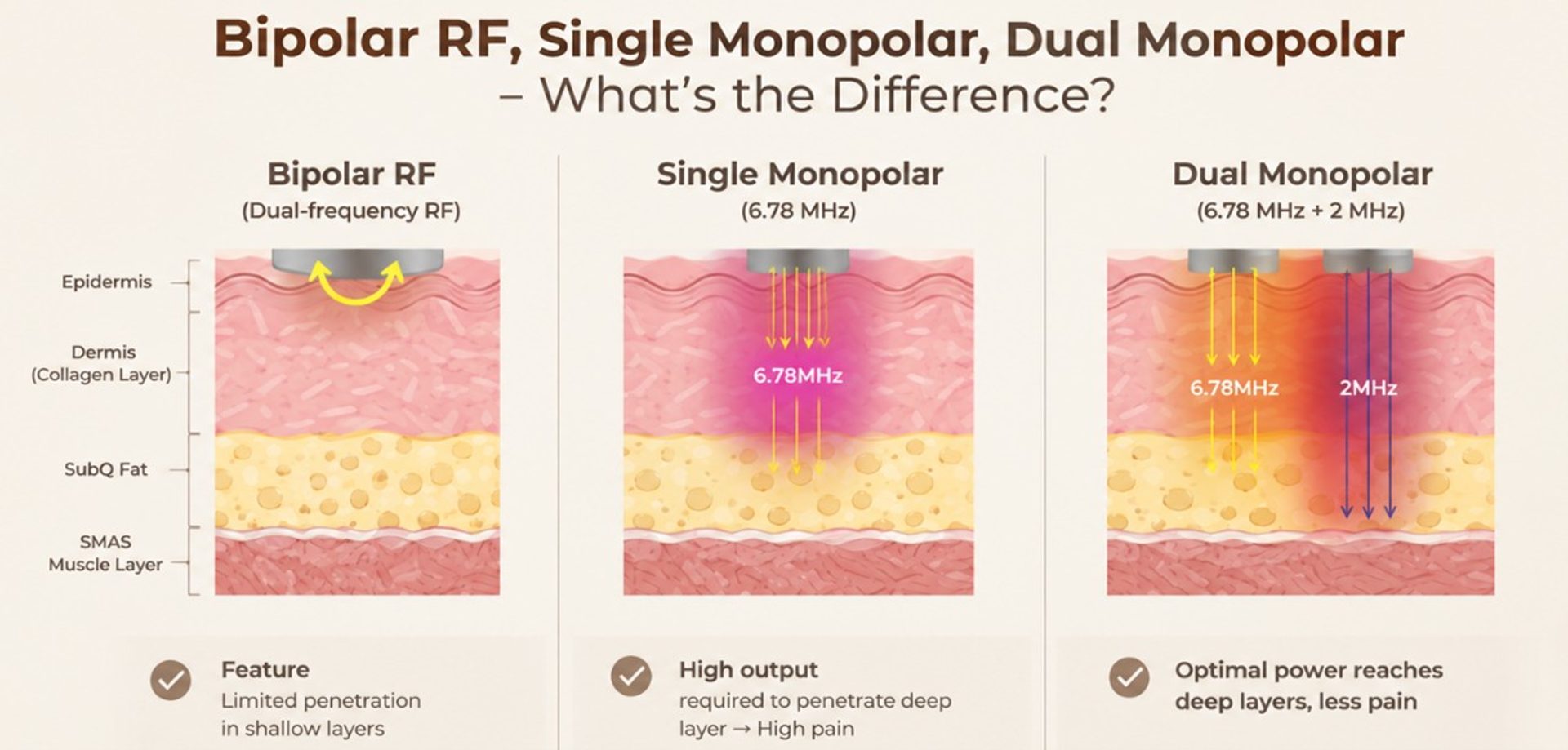 Diagram comparing bipolar RF, single monopolar RF at 6.78 MHz, and XERF's dual monopolar 6.78 MHz plus 2 MHz, showing how deep each reaches through the epidermis, dermis, subcutaneous fat and SMAS layer.
