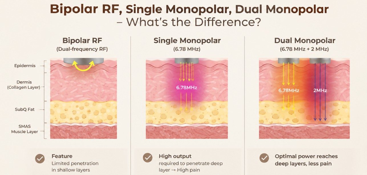 Diagram comparing bipolar RF, single monopolar RF at 6.78 MHz, and XERF's dual monopolar 6.78 MHz plus 2 MHz, showing how deep each reaches through the epidermis, dermis, subcutaneous fat and SMAS layer.