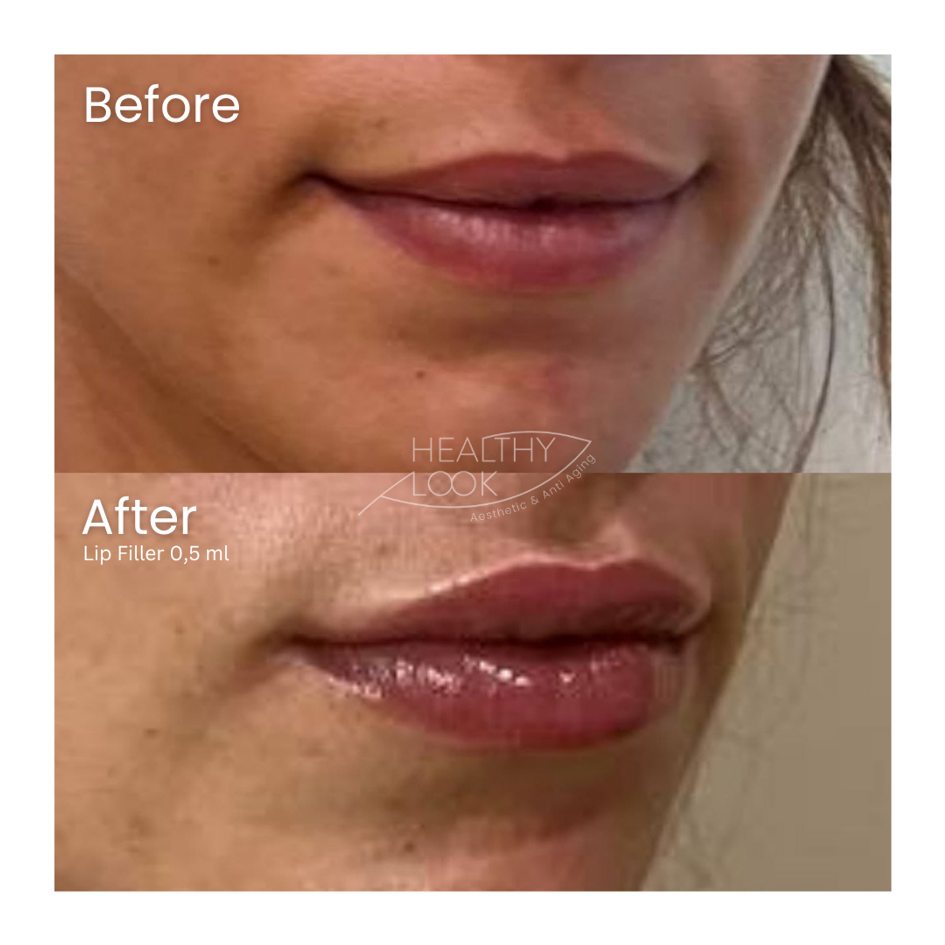 Before and after result 20 for Lip Filler treatment at Healthy Look Aesthetic