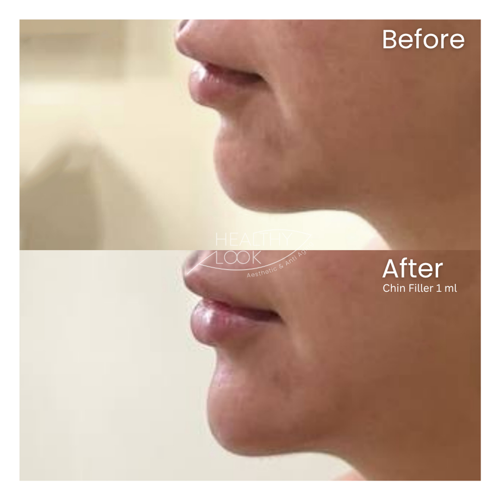 Before and after result 18 for Dermal Filler treatment at Healthy Look Aesthetic