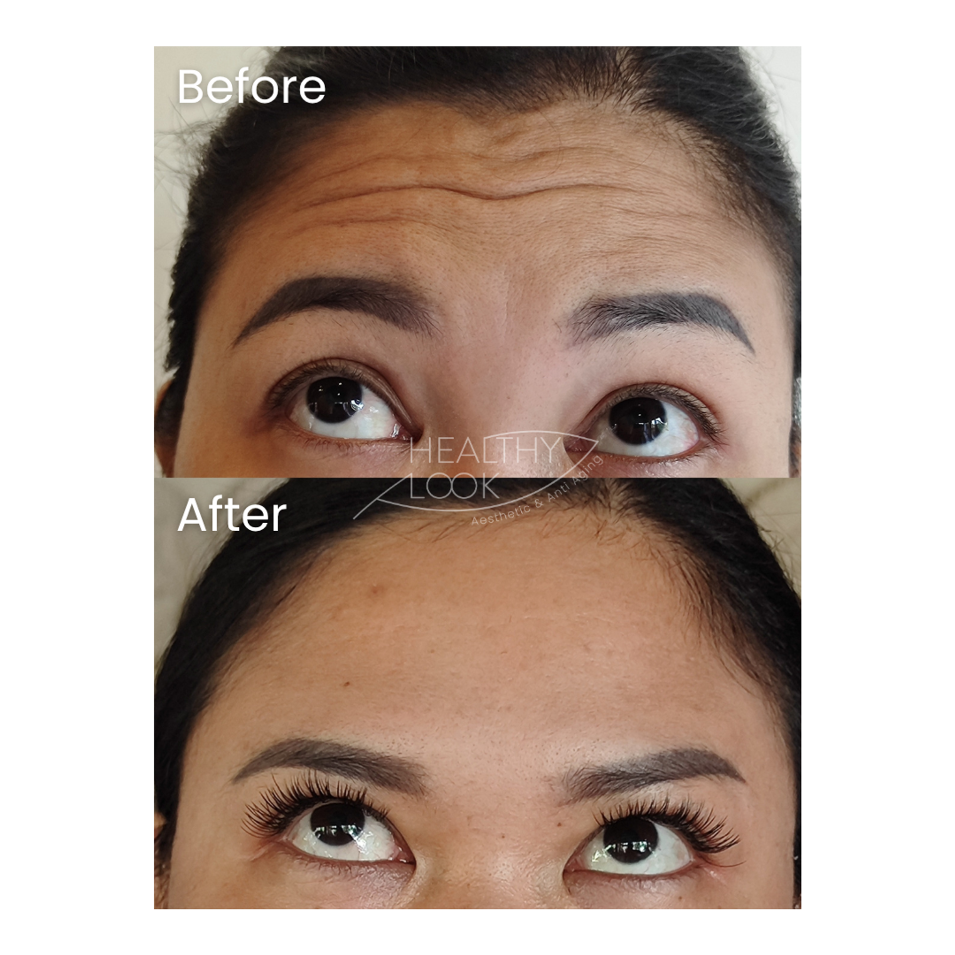 Before and after result 6 for Botox treatment at Healthy Look Aesthetic