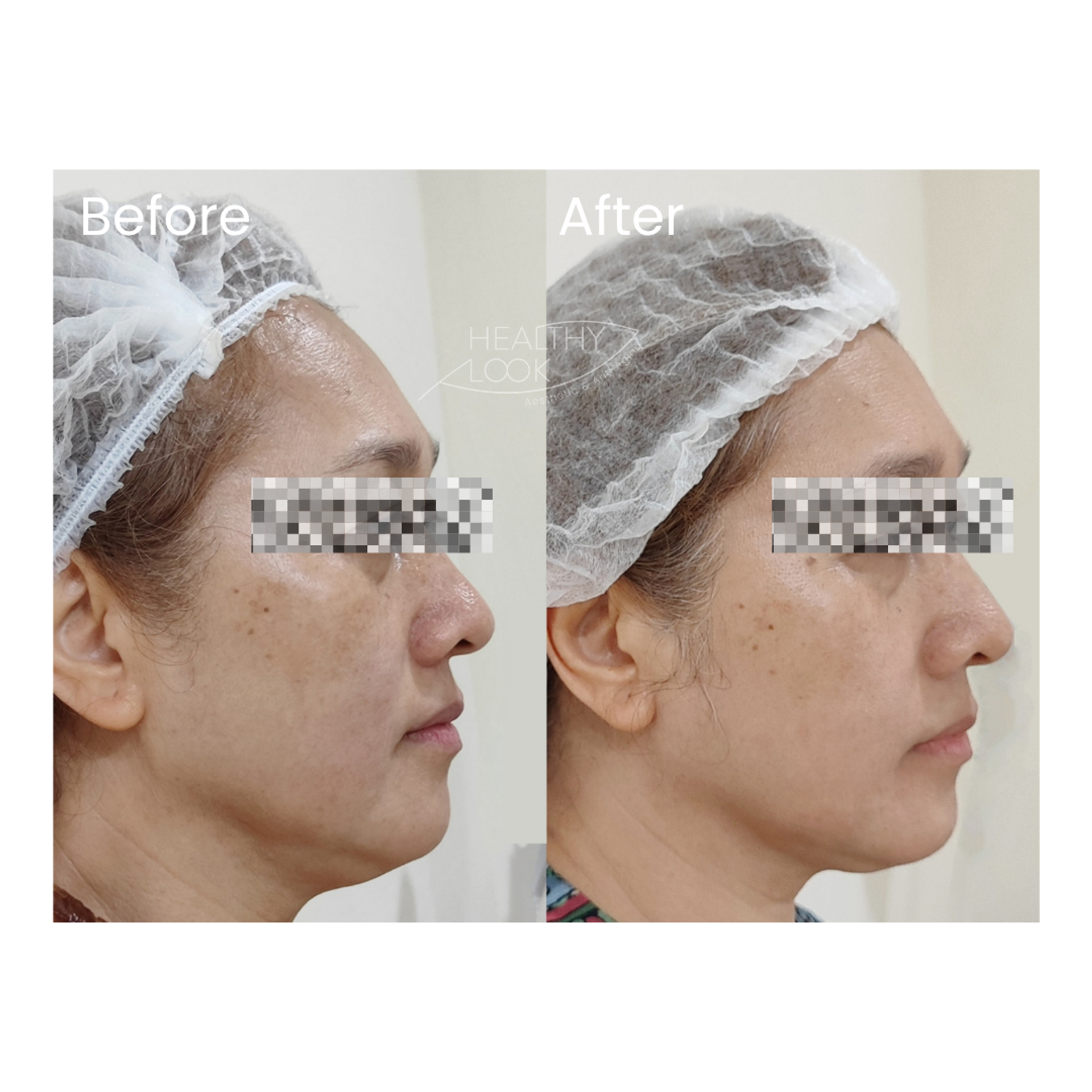 Before and after result 3 for Premium HIFU by Linear Z treatment at Healthy Look Aesthetic