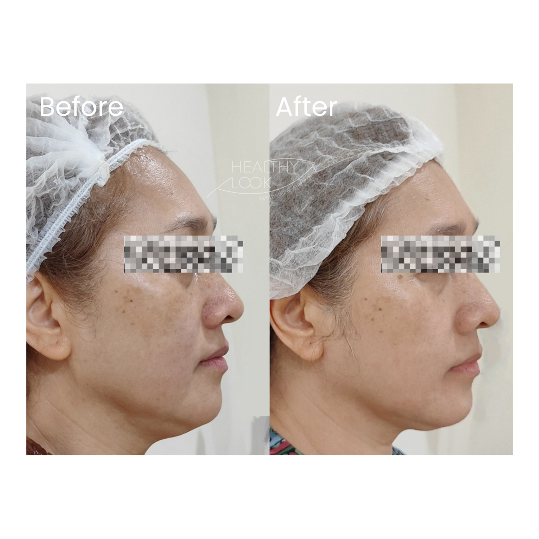 Before and after result 3 for Premium HIFU by Linear Z treatment at Healthy Look Aesthetic