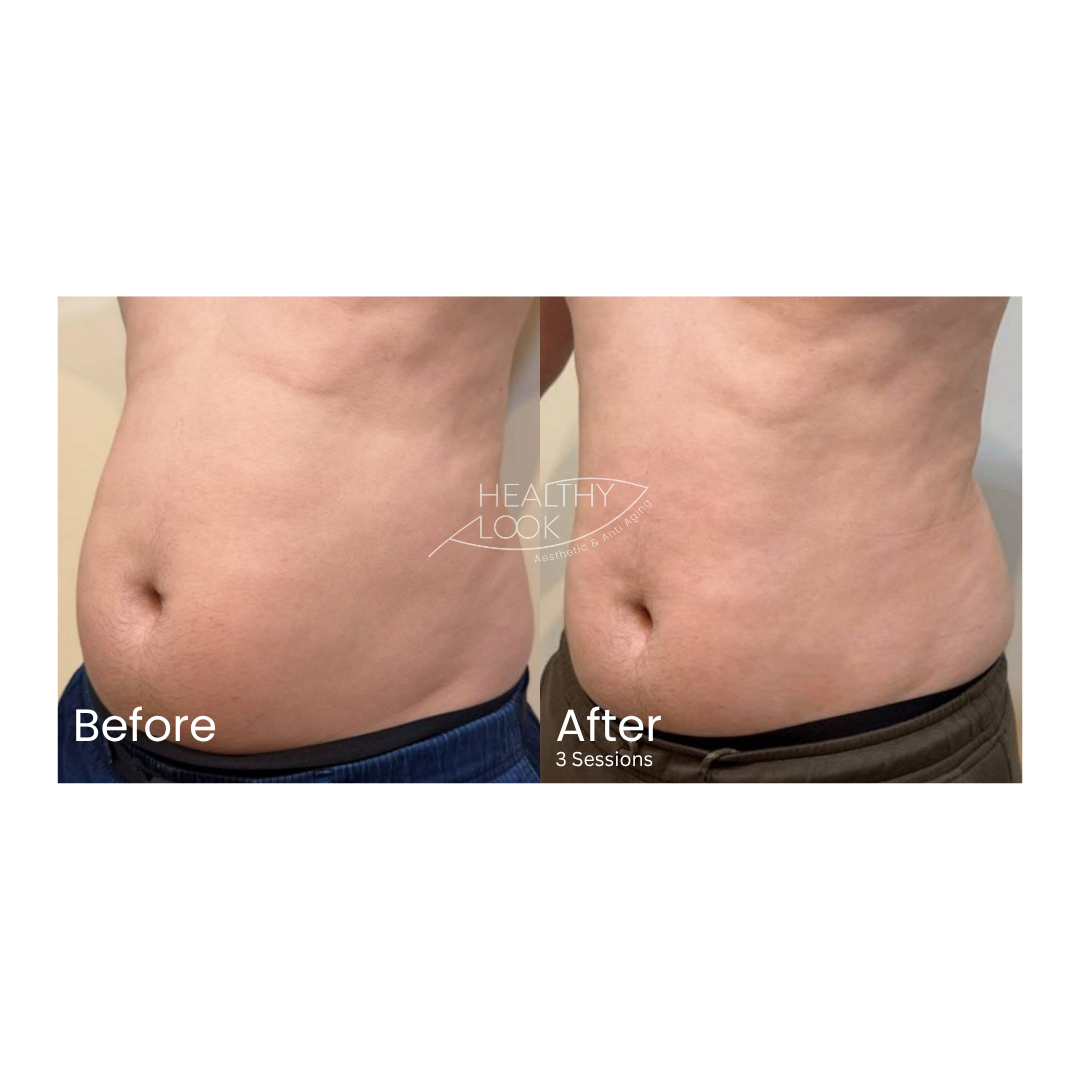 Before and after result 3 for CE Certified Muscle Sculpting by CM Slim treatment at Healthy Look Aesthetic