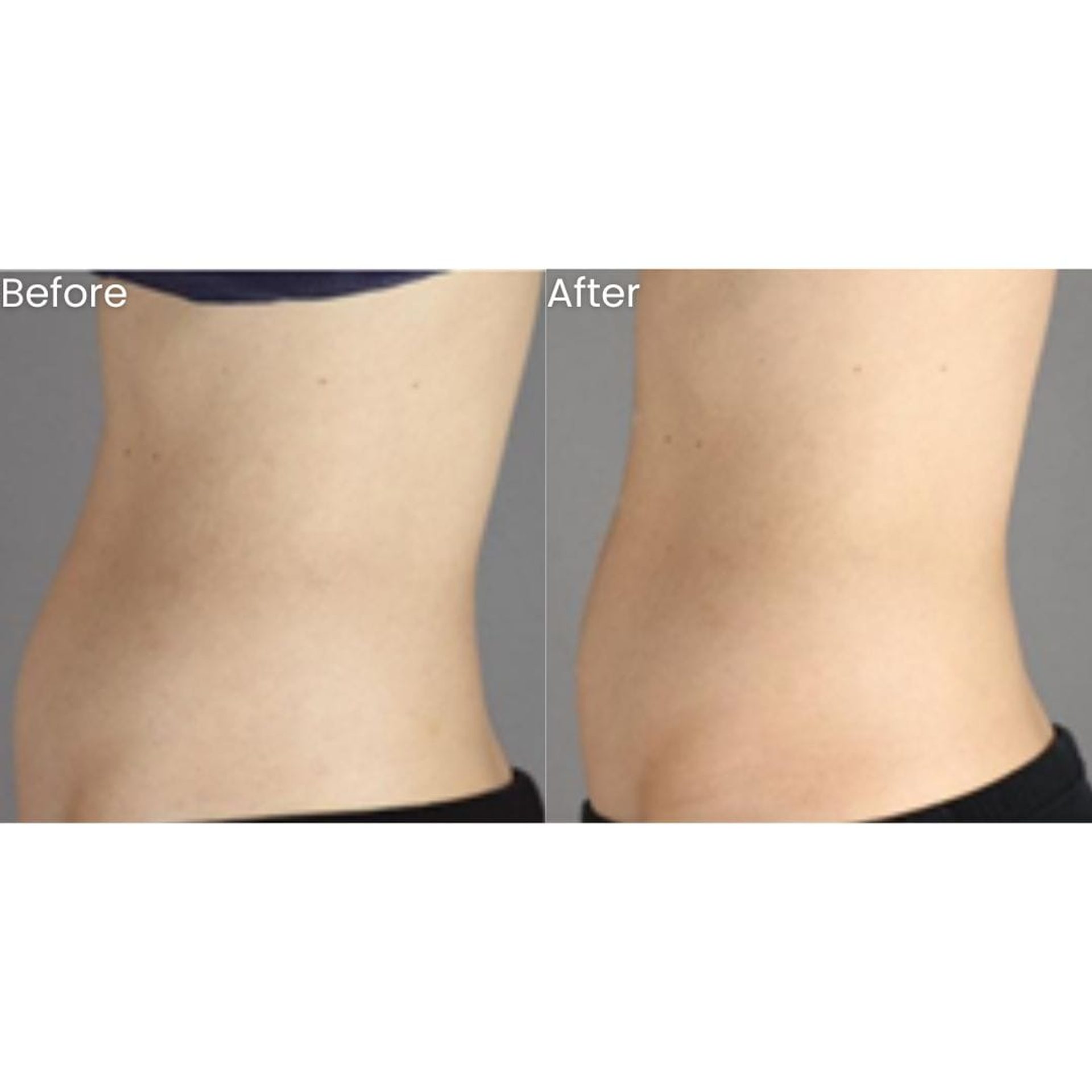 Before and after HIFU Body at Healthy Look Aesthetic, Ubud